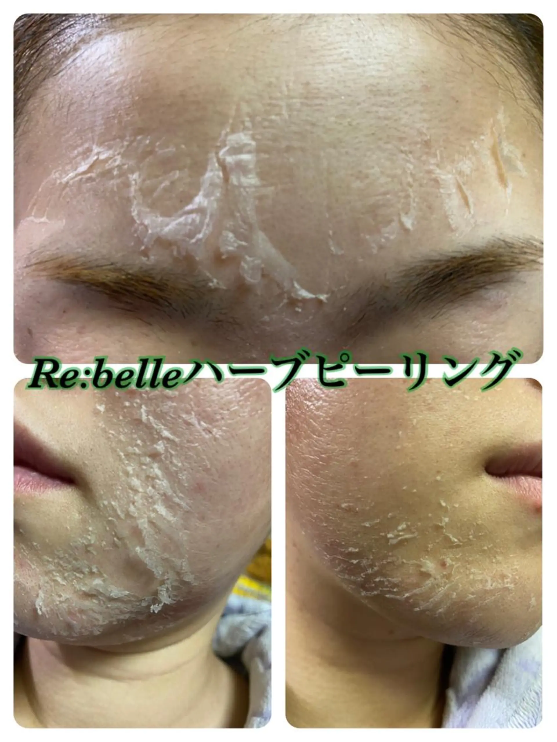 エステ 【リベルハーブピーリング認定店】敏感肌・美白脱毛専門店Dione立川店所属・Dione 立川店のエステ・リラクイメージ