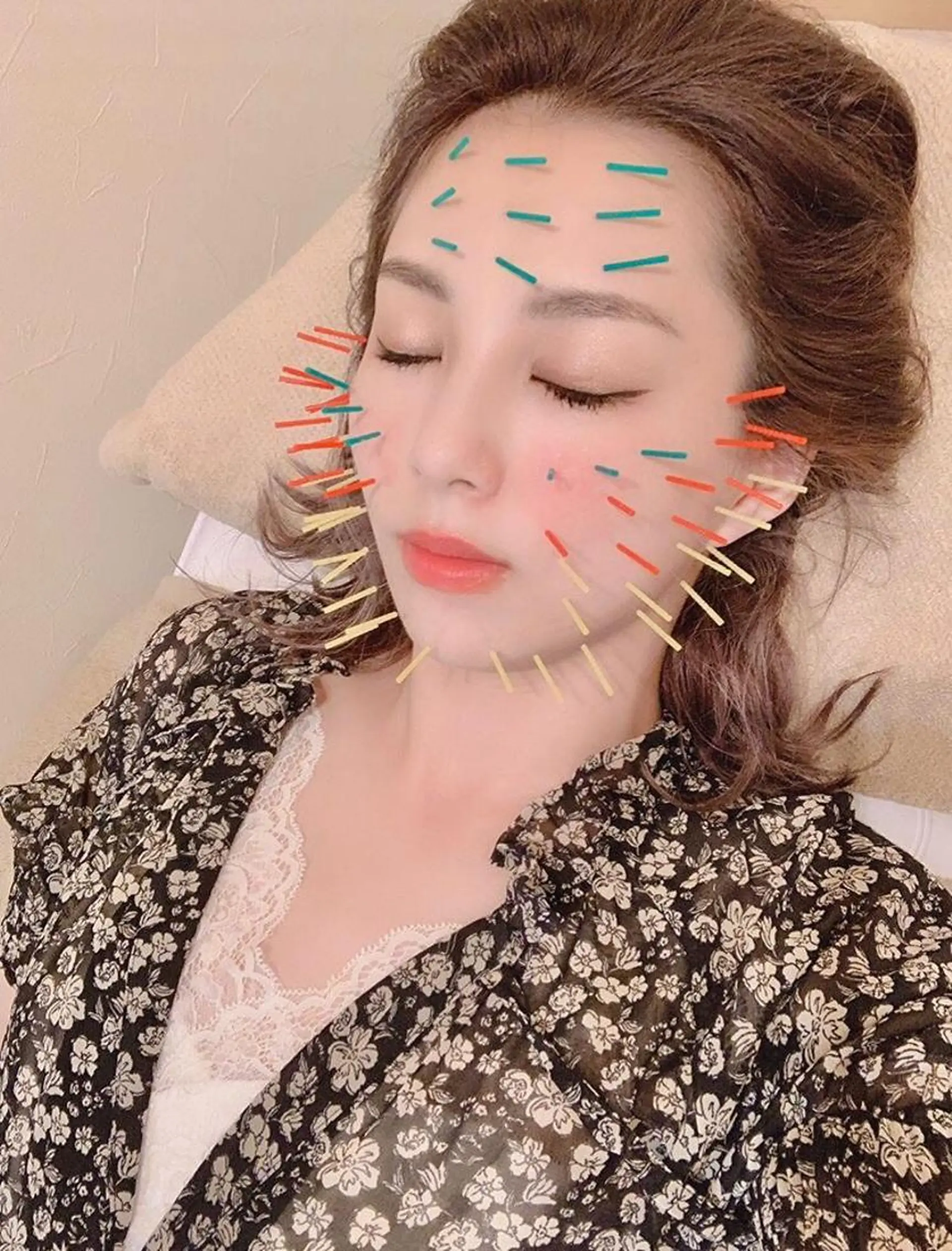 鍼灸整骨院Refine所属・鍼灸 Refineのその他イメージ