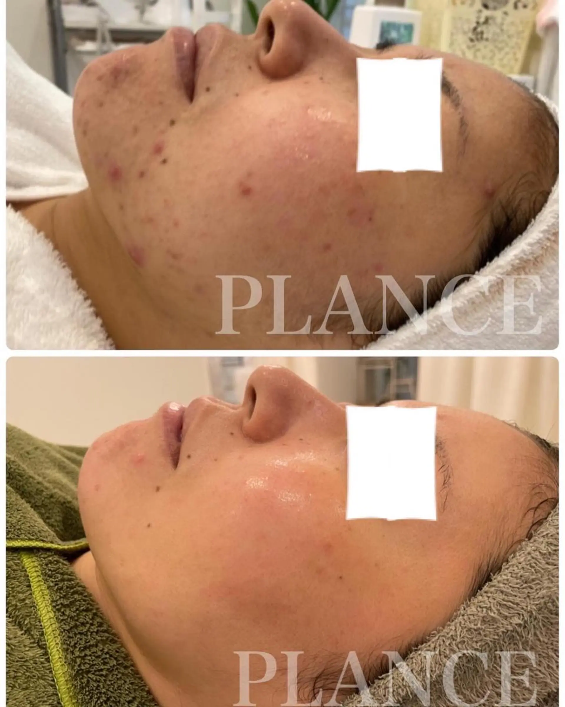 エステ フェイシャル専門 肌質改善/プランスのエステ・リラクイメージ