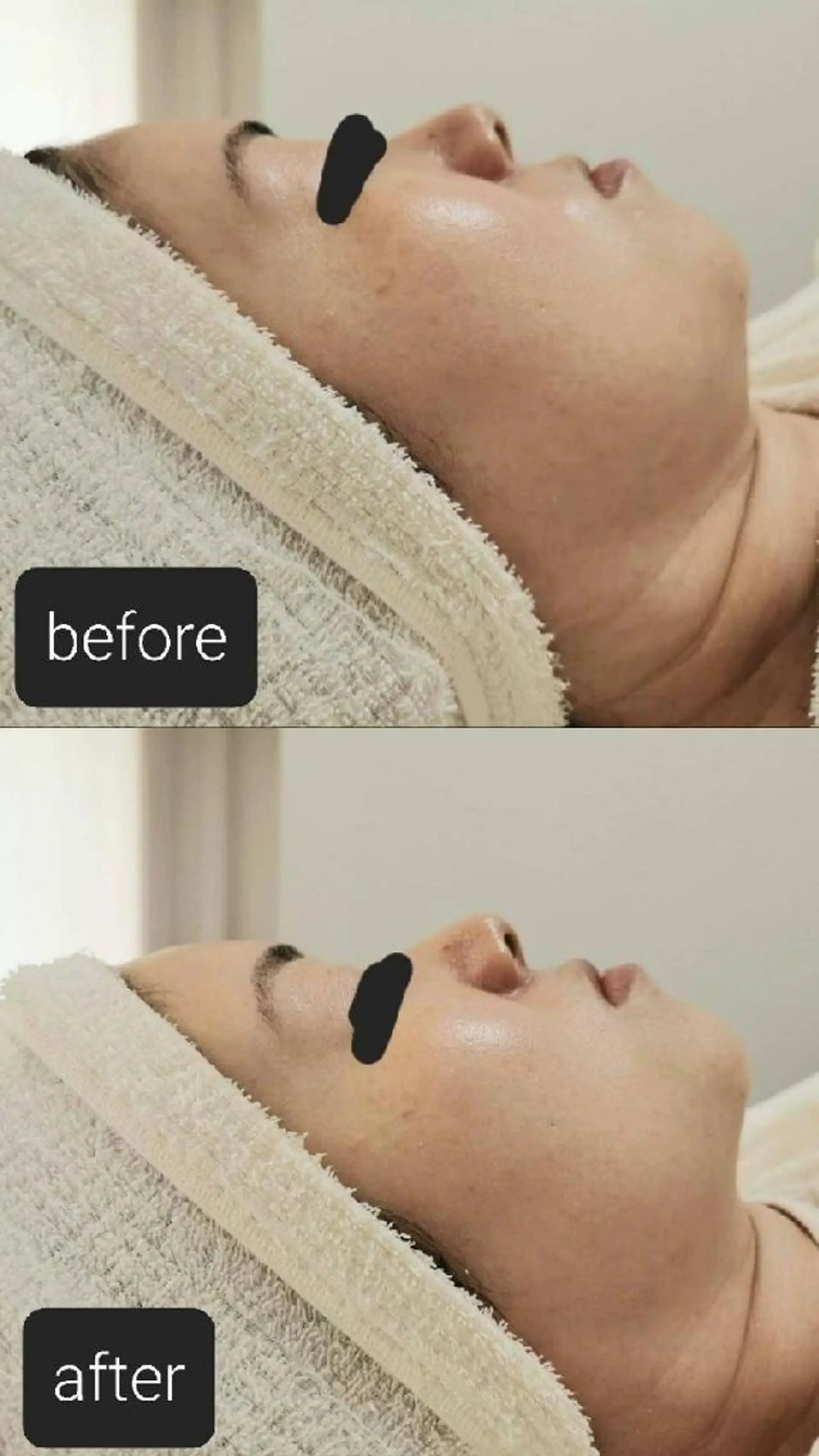 ニキビケア◇ニキビ跡 レゾン京橋店　峠山のエステ・リラクイメージ