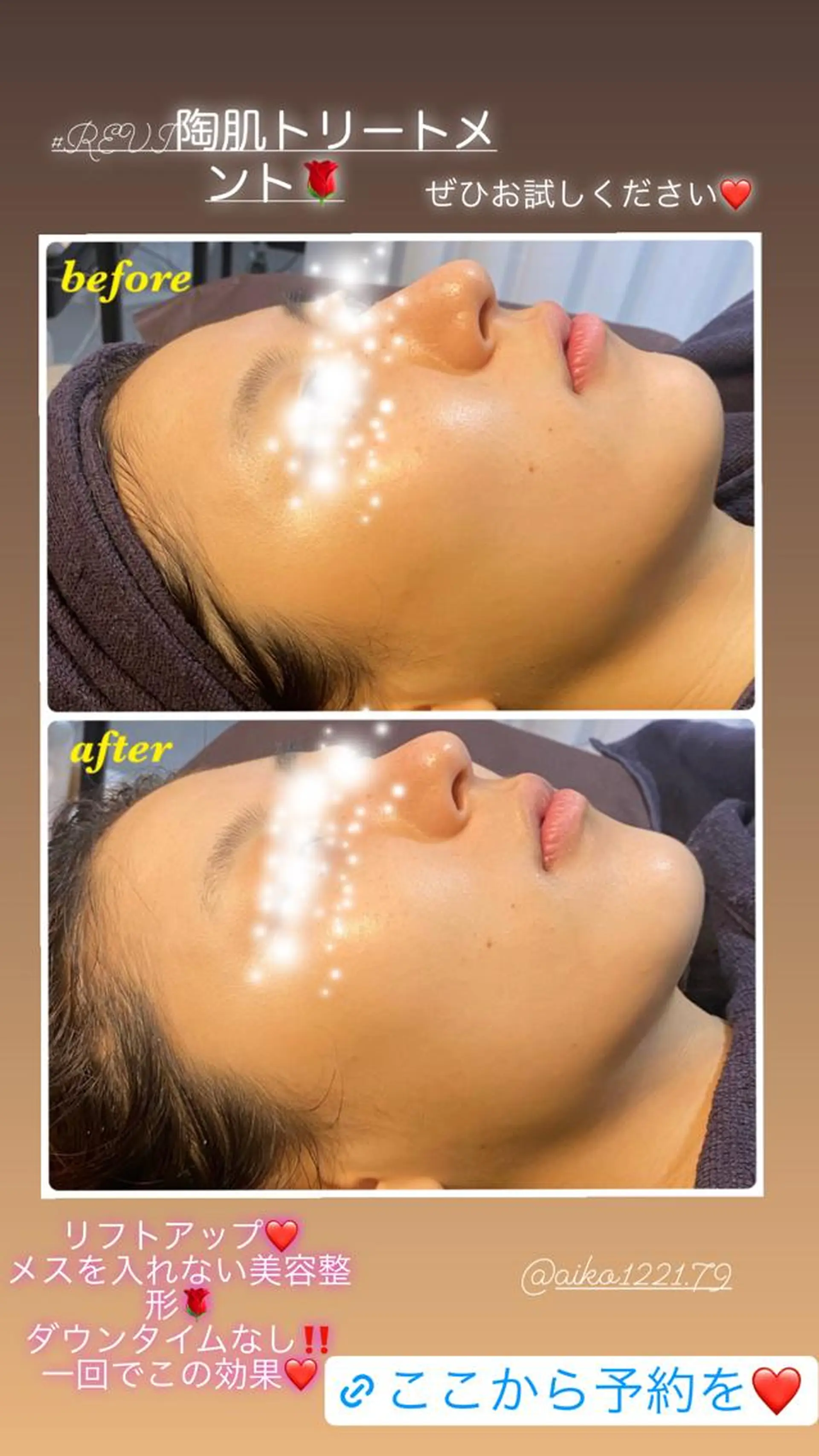 ハーブピーリング/韓国肌管理/フェイシャル/毛穴洗浄/眉毛/顔脱毛【糸脱毛専門】rev所属・ハーブピーリング専門 毛穴洗浄❤️眉waxのエステ・リラクイメージ