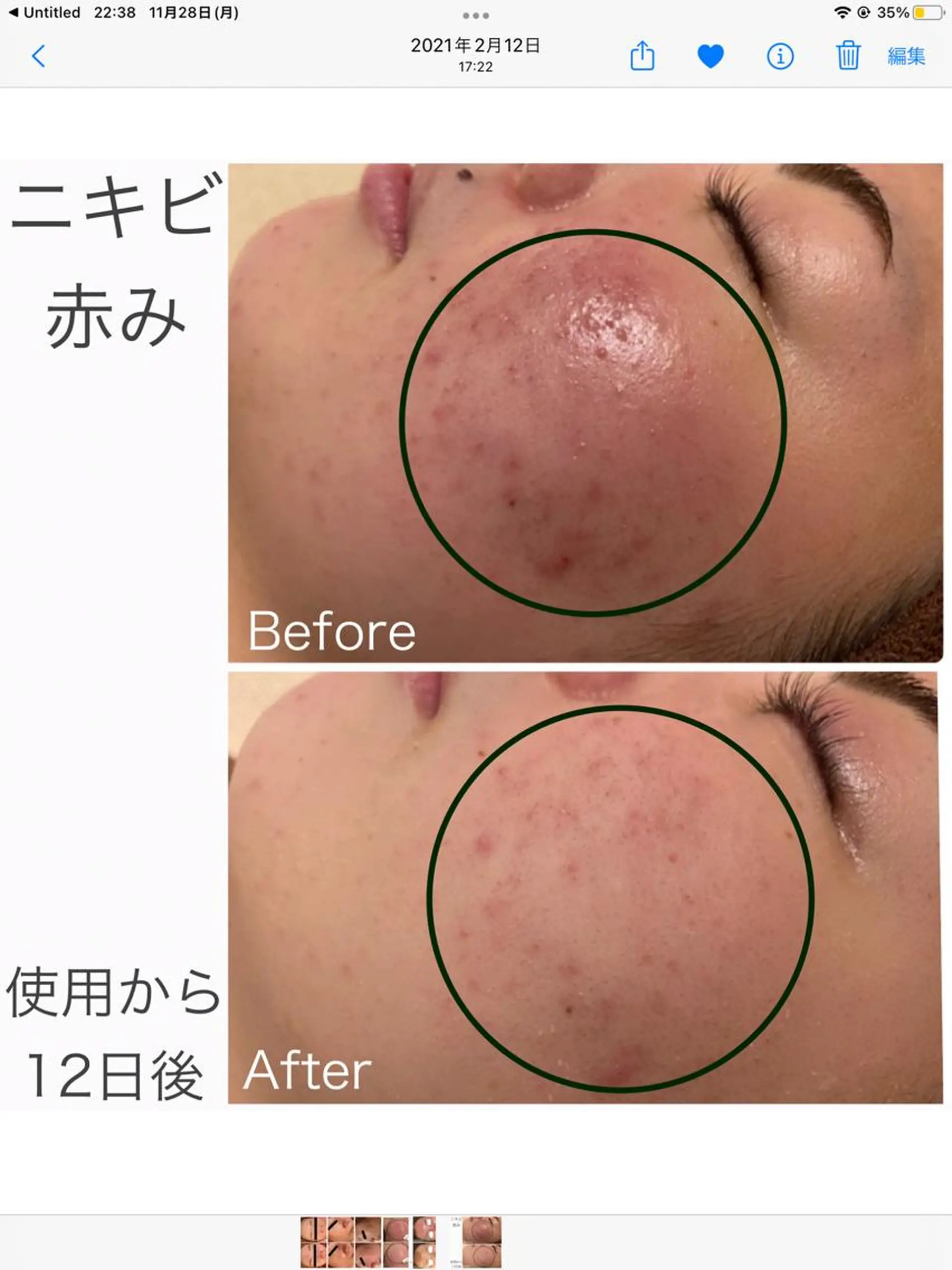 エステ リラク ニキビ跡改善専門🔥 医療にはできない改善のエステ・リラクイメージ