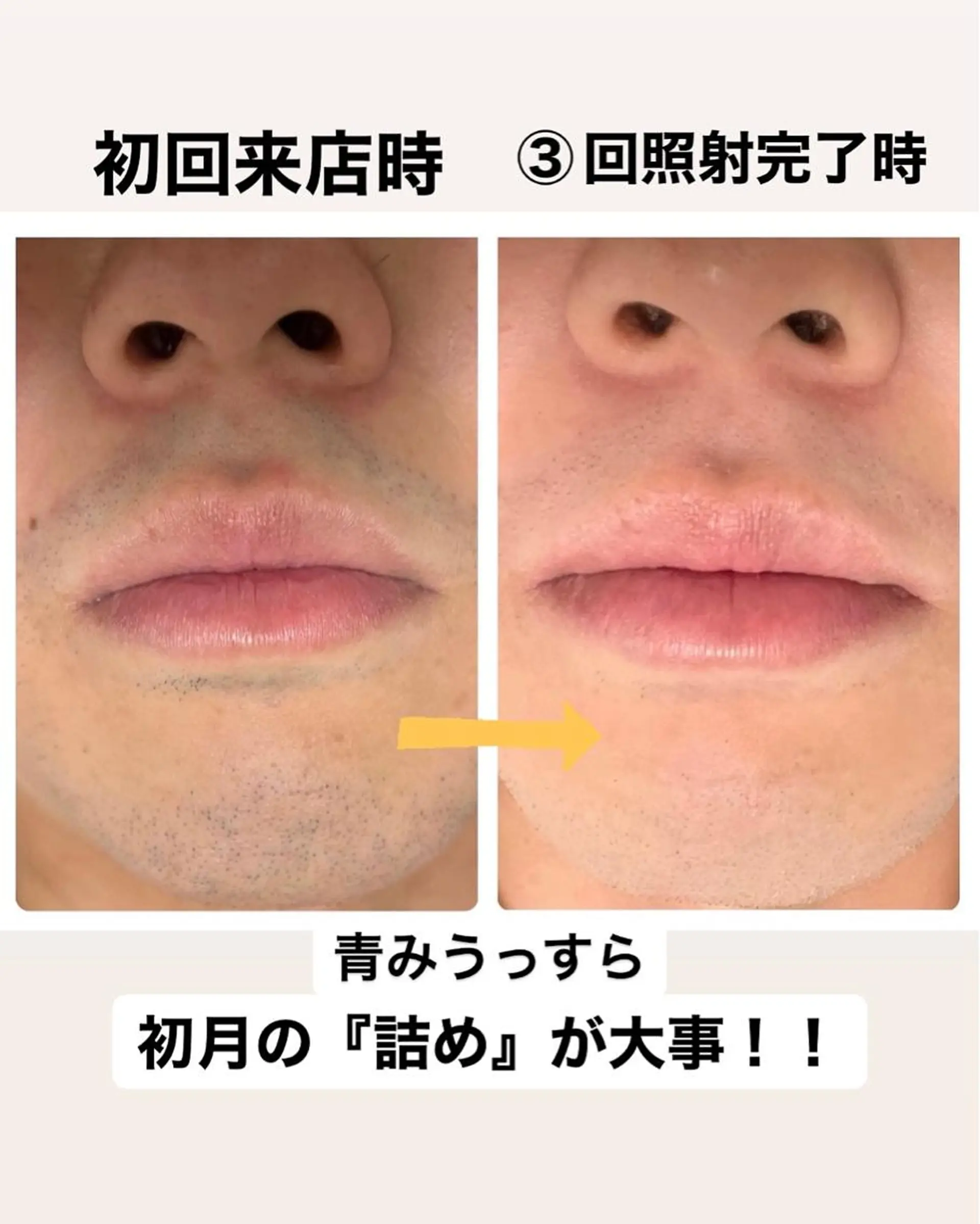 メンズ メンズハイライト 脱毛 メンズ脱毛サロン Le falcoのエステ・リラクイメージ