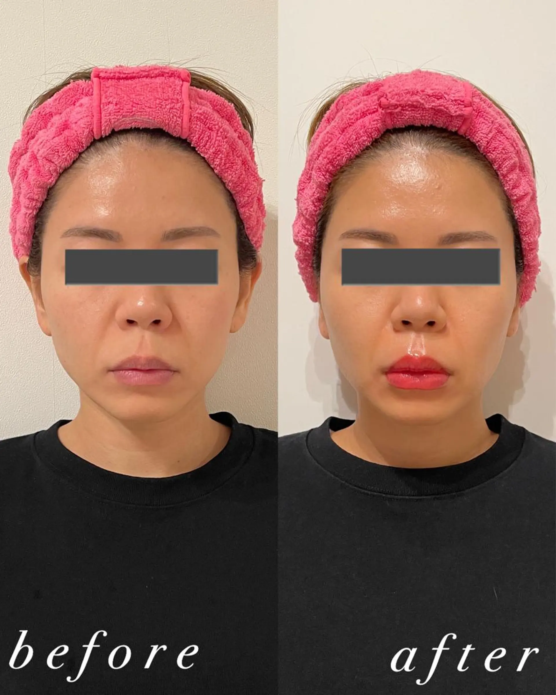 うなじ脱毛/美肌脱毛 LABELのエステ・リラクイメージ