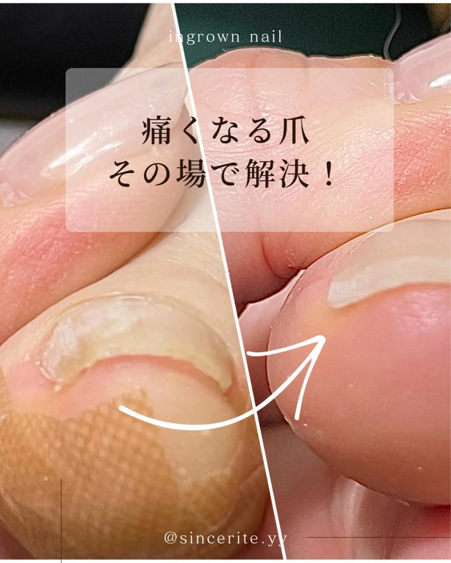 ネイル 深爪・巻き爪 専門サンセリテのネイルデザイン