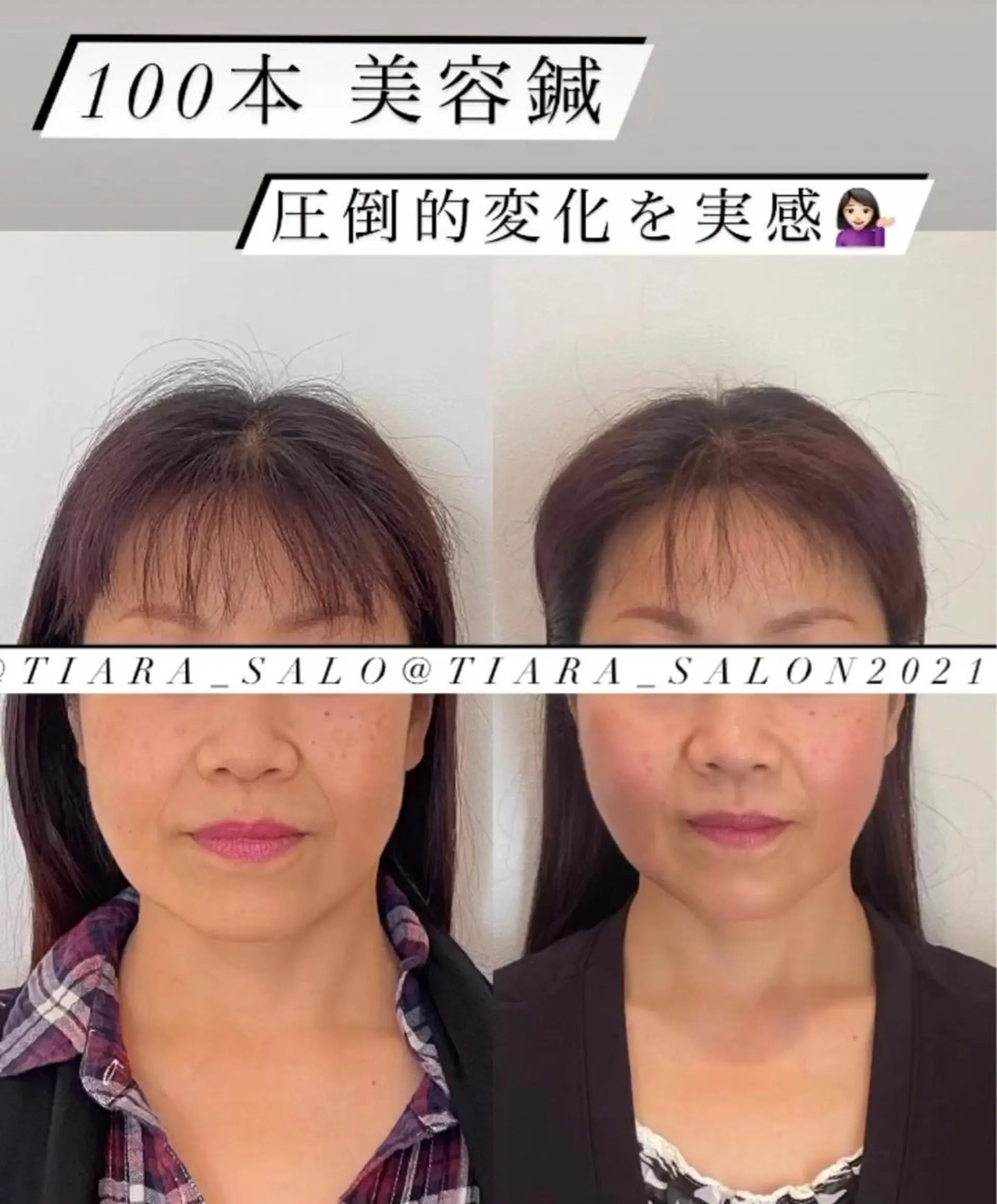 セミロング カラー パーマ ヘアアレンジ メンズ キッズ ネイル マツエク・マツパ アイブロウ 美容鍼灸サロン　TIARA所属・鍼灸サロン TIARA　美容鍼のエステ・リラクイメージ