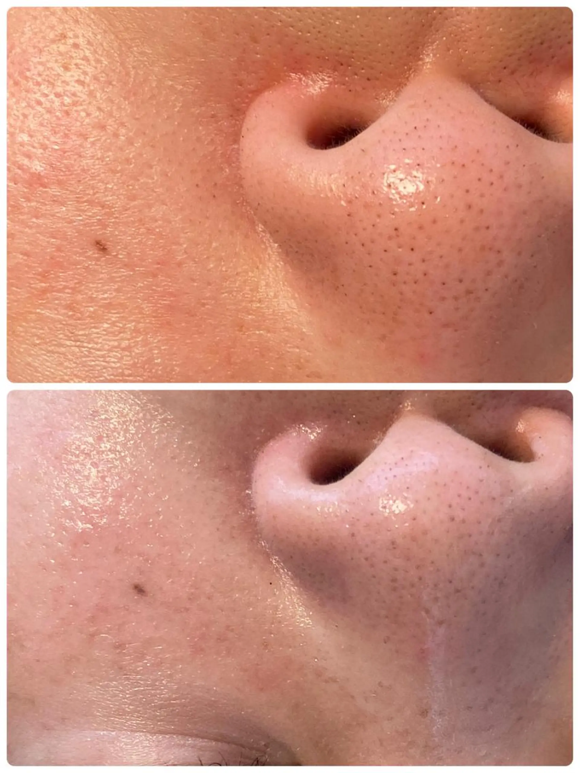 小顔・毛穴/ニキビ/ ハーブピーリング専門のエステ・リラクイメージ