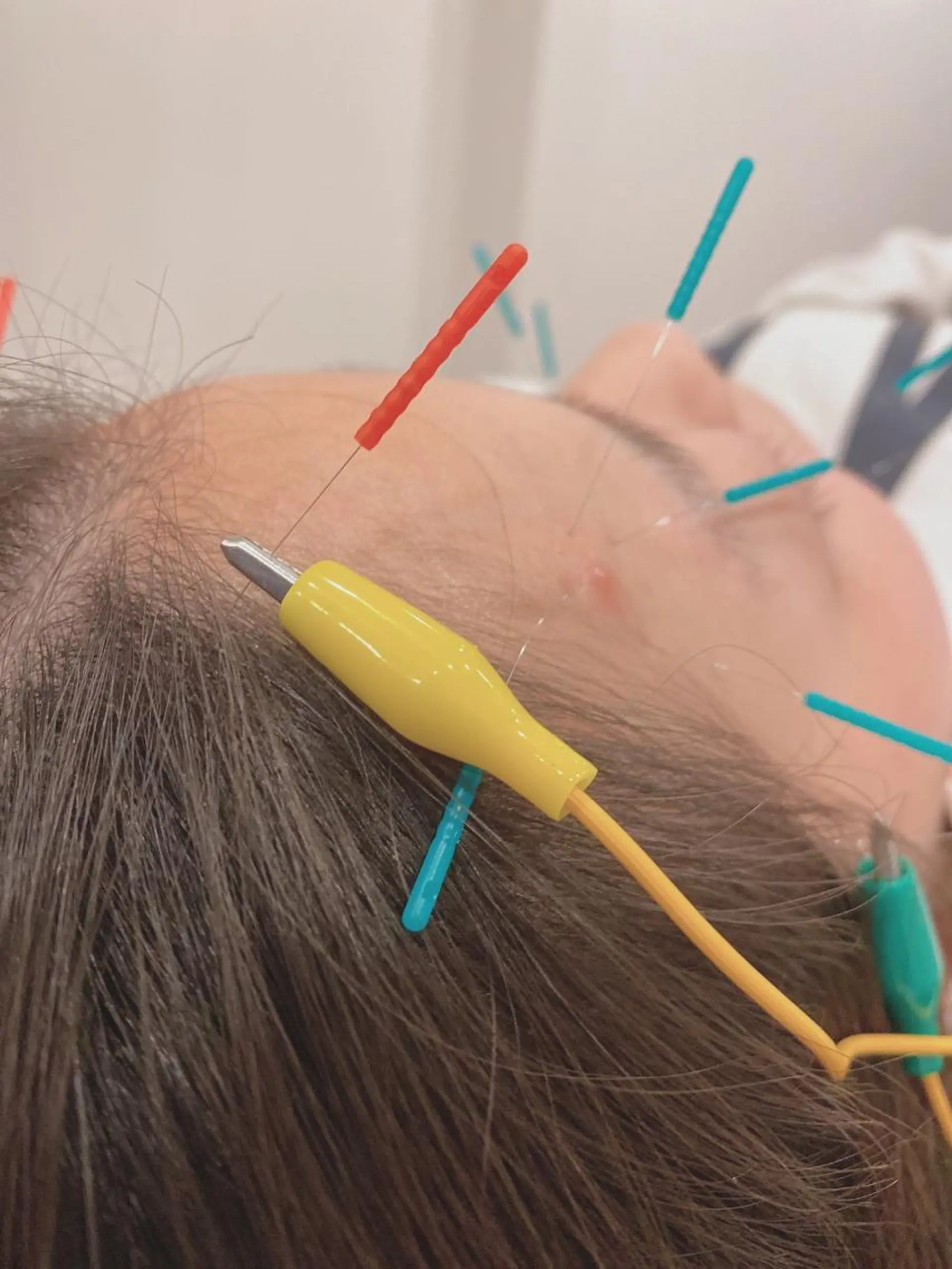 エステ リラク 美容鍼灸Solana所属・肌質改善×美容鍼 ゆいのエステ・リラクイメージ