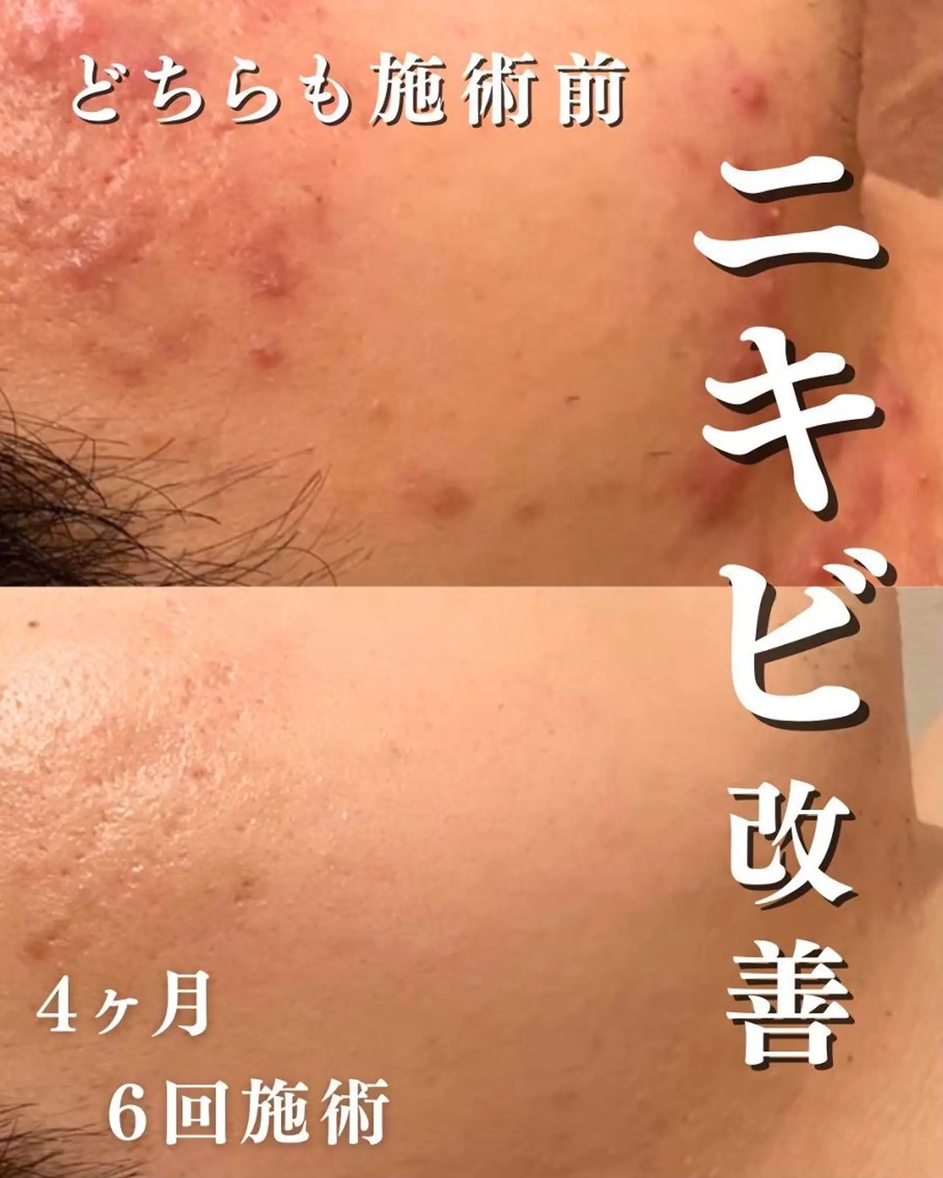 ニキビ跡改善専門🔥 医療にはできない改善のエステ・リラクイメージ