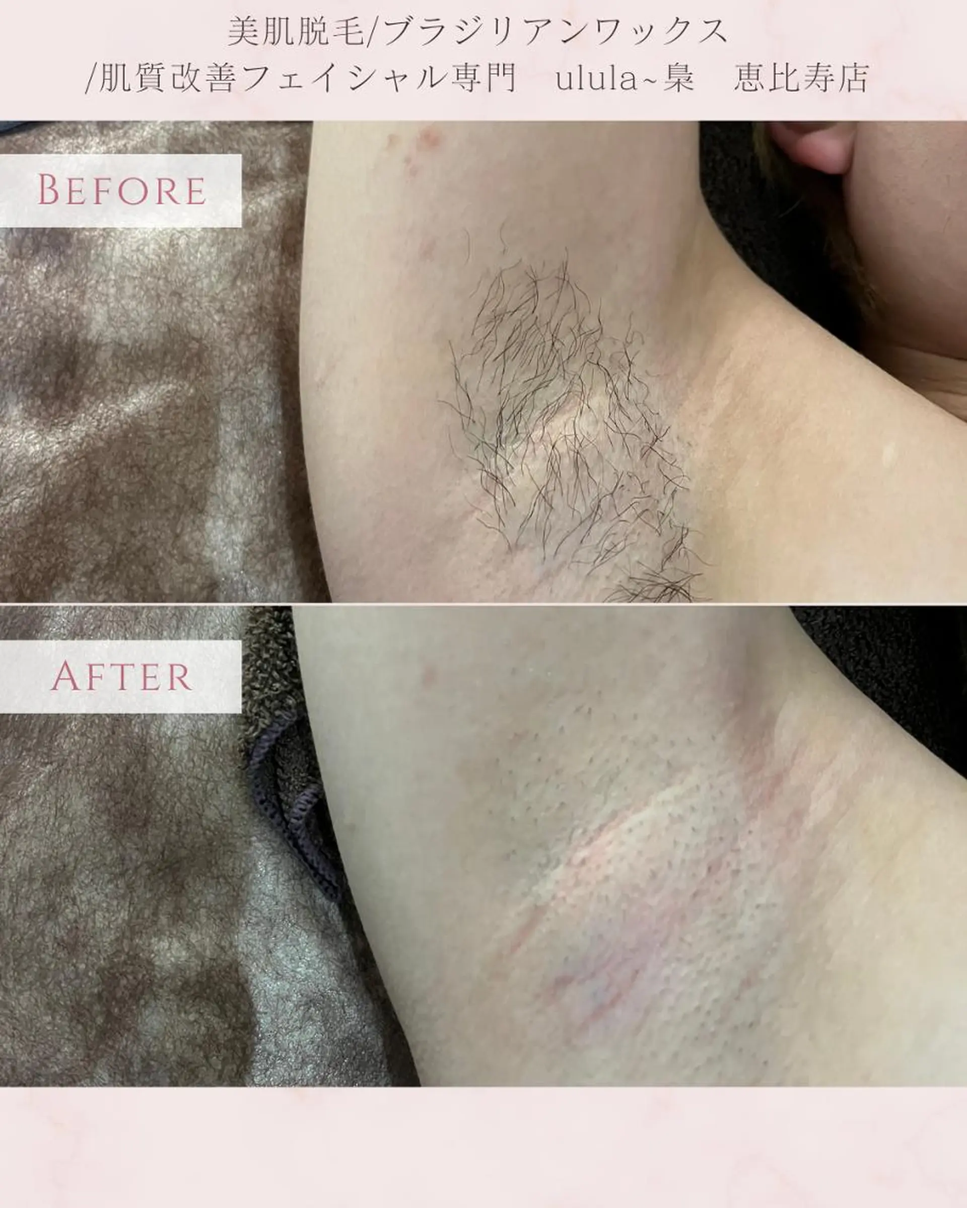 脱毛 美肌脱毛/肌質改善 《ulula～梟》のエステ・リラクイメージ