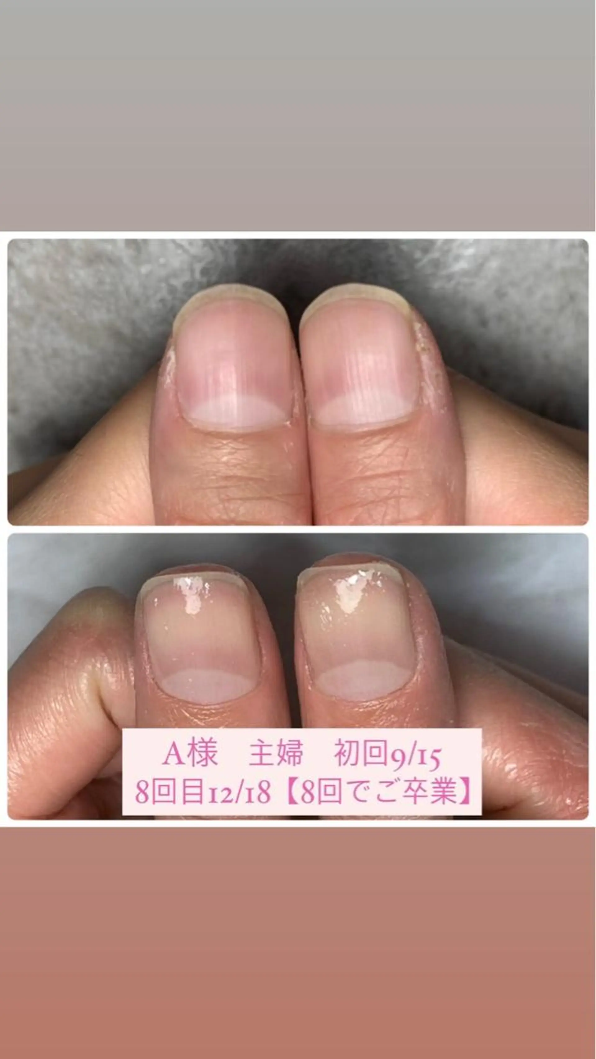 ネイル 自爪育成/深爪矯正 mikiのネイルデザイン