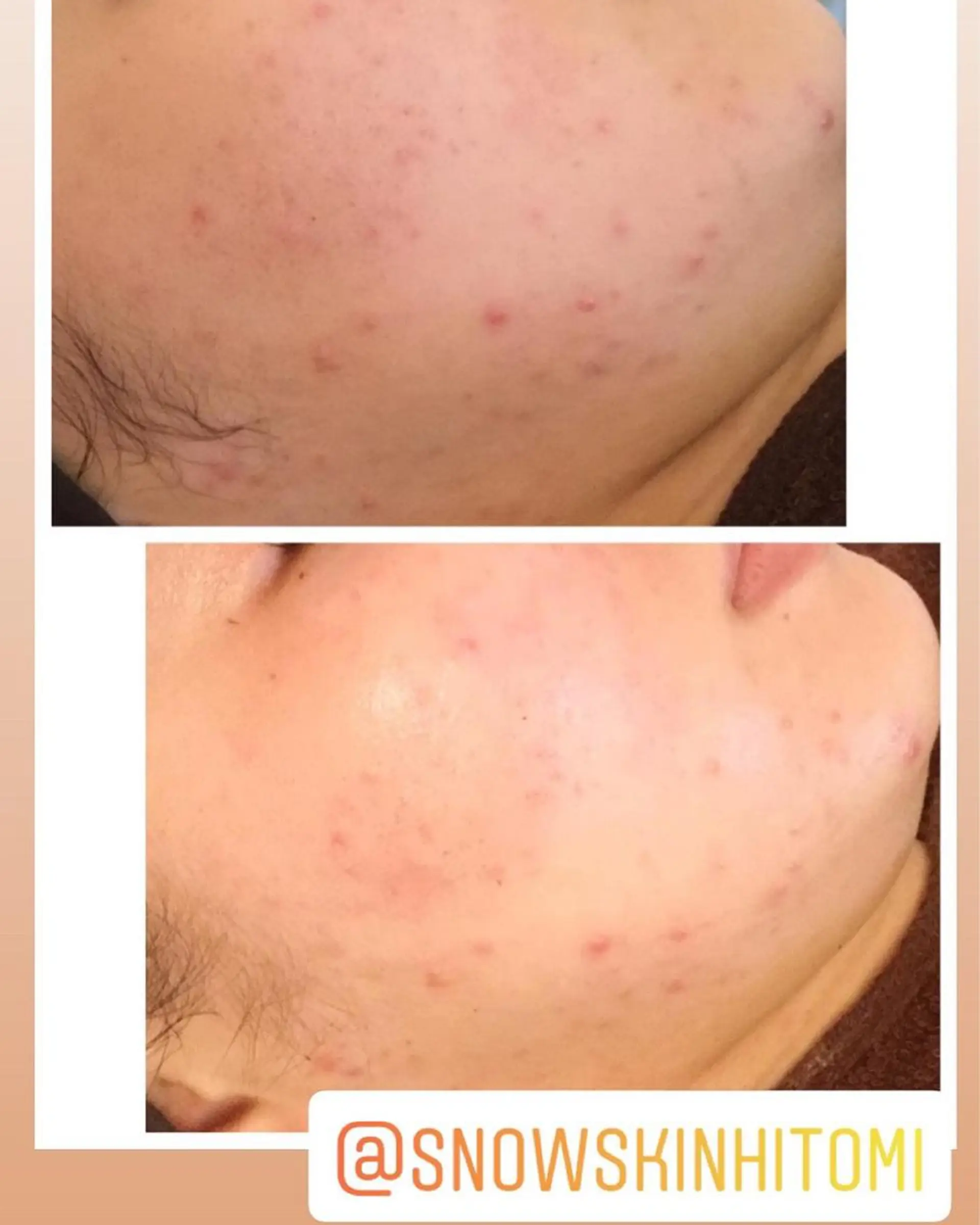 ニキビ/肌質改善専門 Snow skinのエステ・リラクイメージ