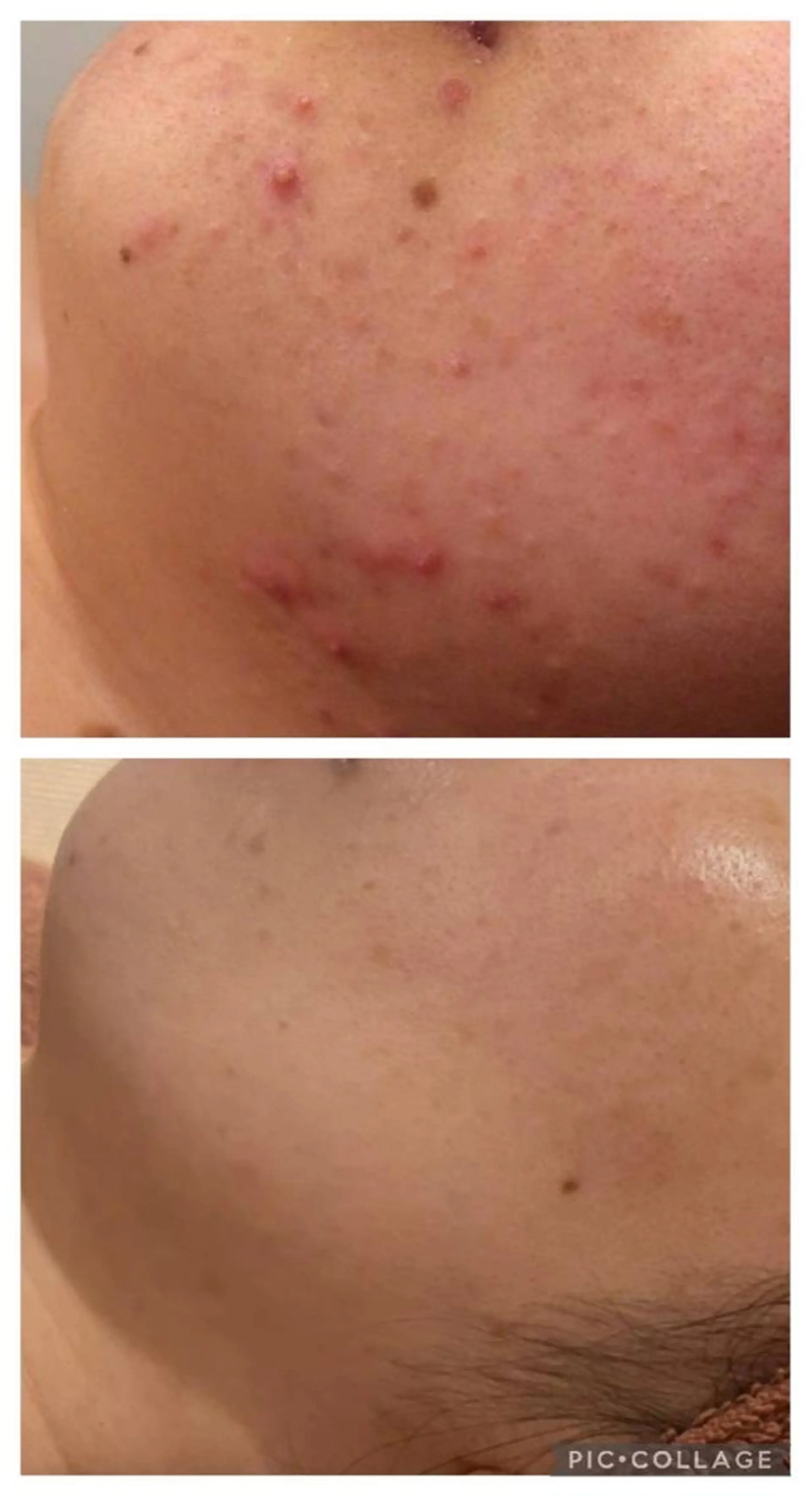 ロング カラー パーマ ヘアアレンジ メンズ キッズ ネイル マツエク・マツパ アイブロウ エステ リラク ニキビ特化型エステ 🍋最短で肌質改善のエステ・リラクイメージ