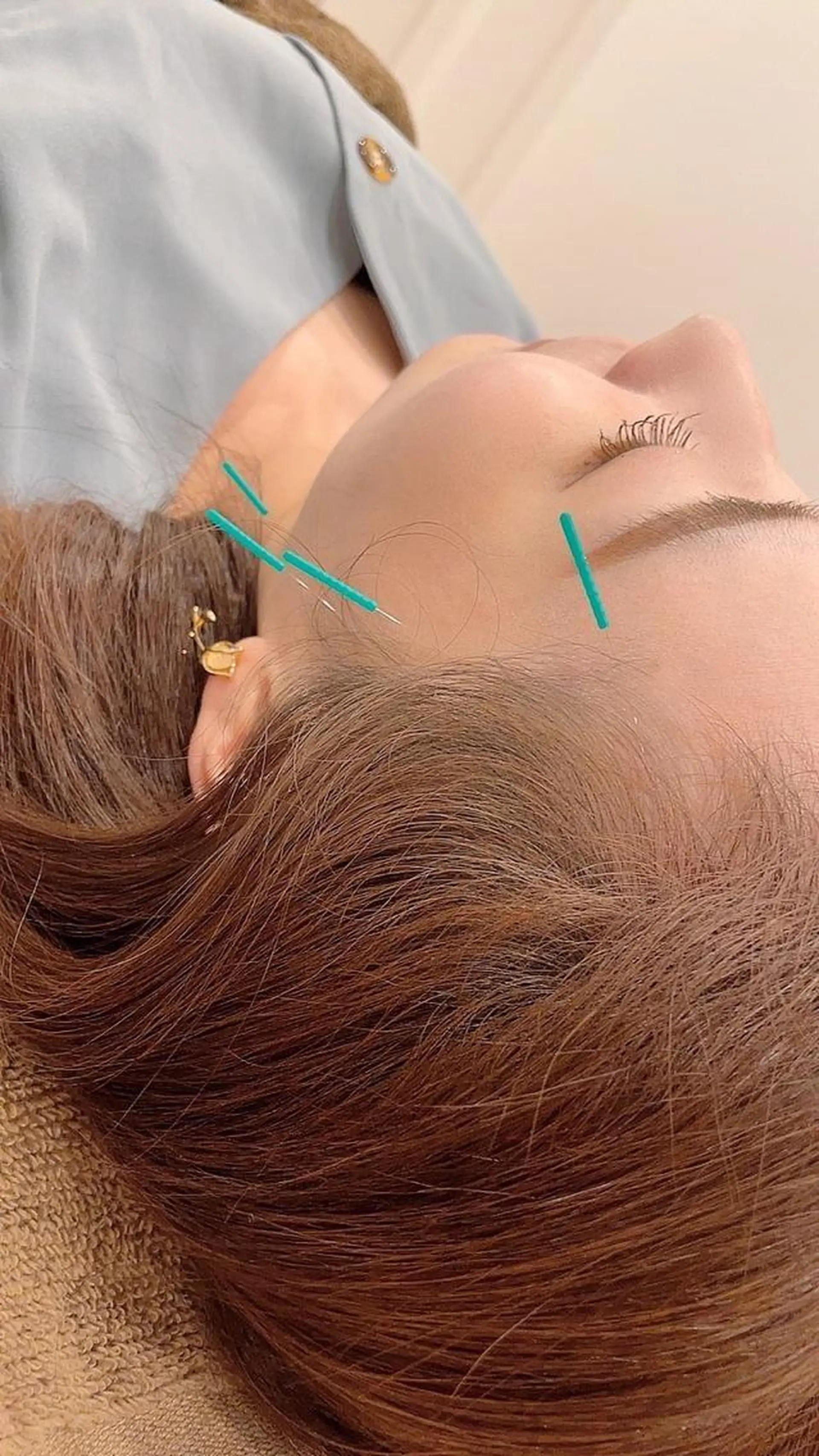 エステ リラク 肌質改善×美容鍼 ゆいのエステ・リラクイメージ