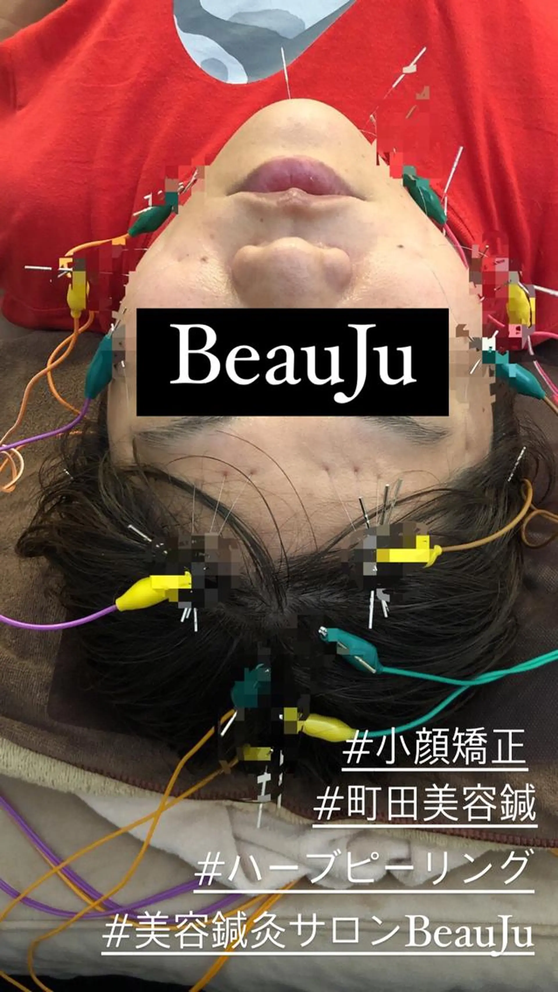 その他 美容鍼灸整体サロンBeauJu所属・小顔矯/美容鍼/鍼灸 BeauJuのその他イメージ