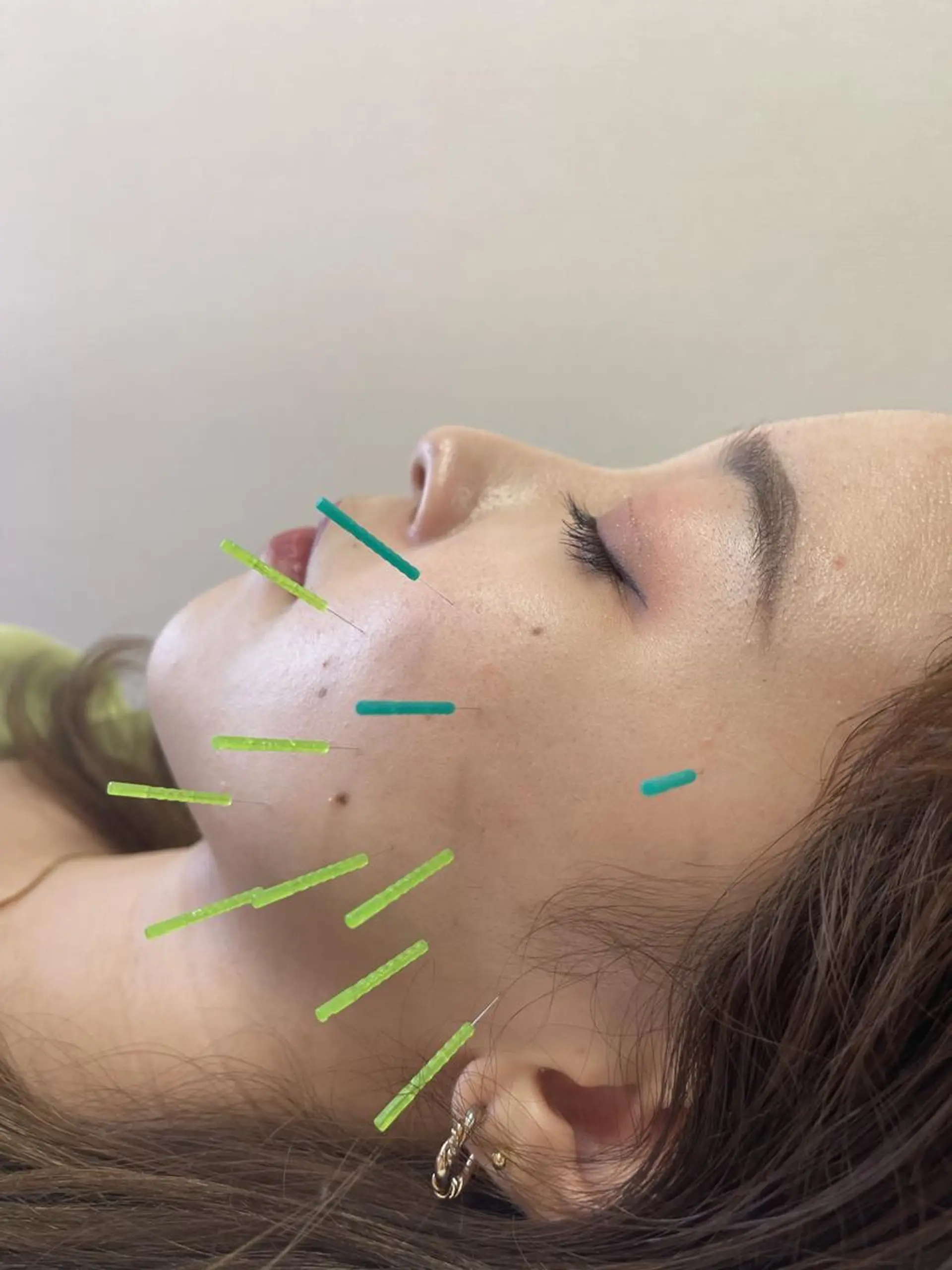 エステ リラク 同心整骨院 美容鍼・整体・小顔のエステ・リラクイメージ