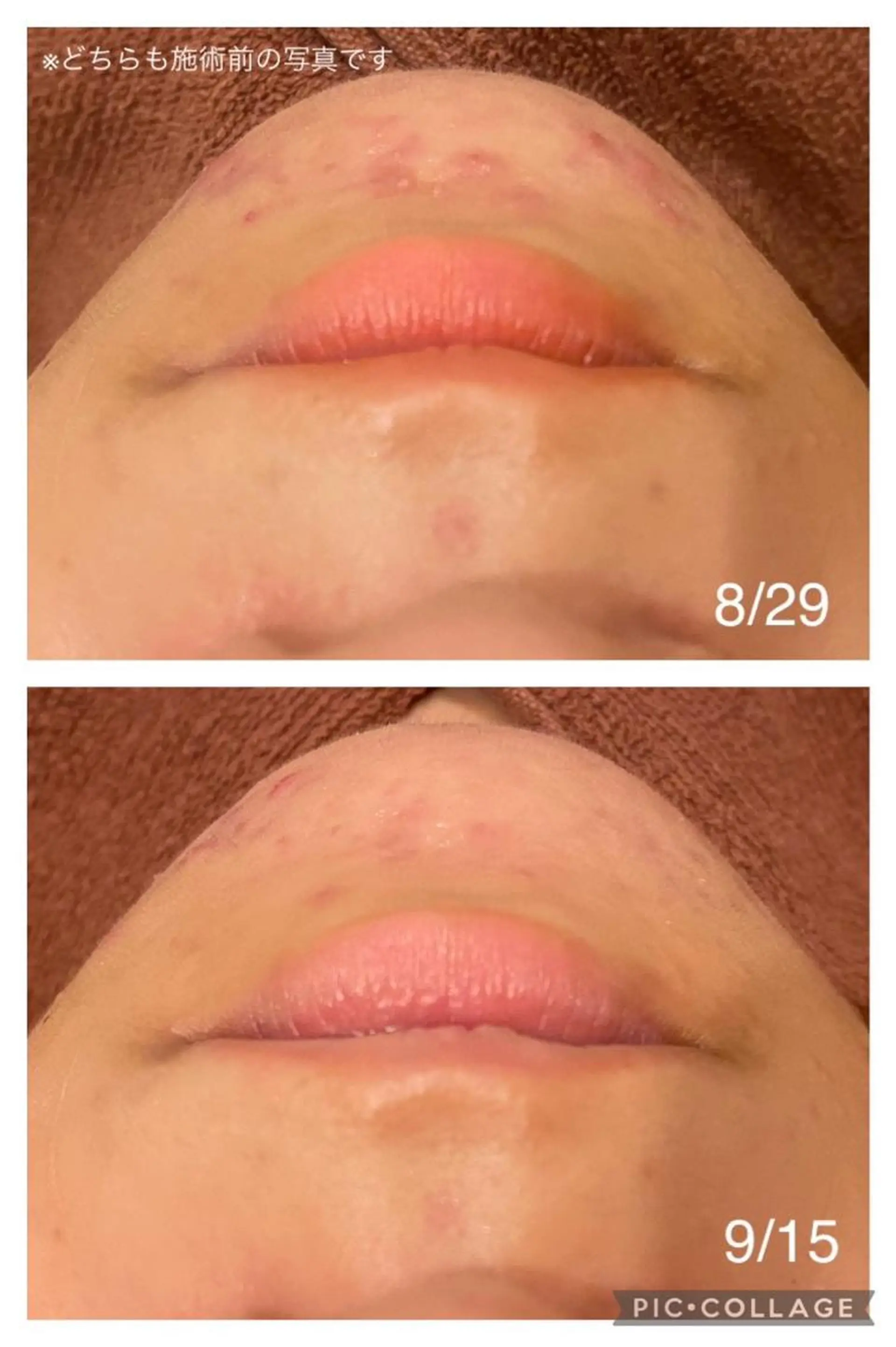 セミロング カラー パーマ ヘアアレンジ メンズ キッズ ネイル マツエク・マツパ アイブロウ 3か月で肌革命👼 ニキビ専門店💫のエステ・リラクイメージ