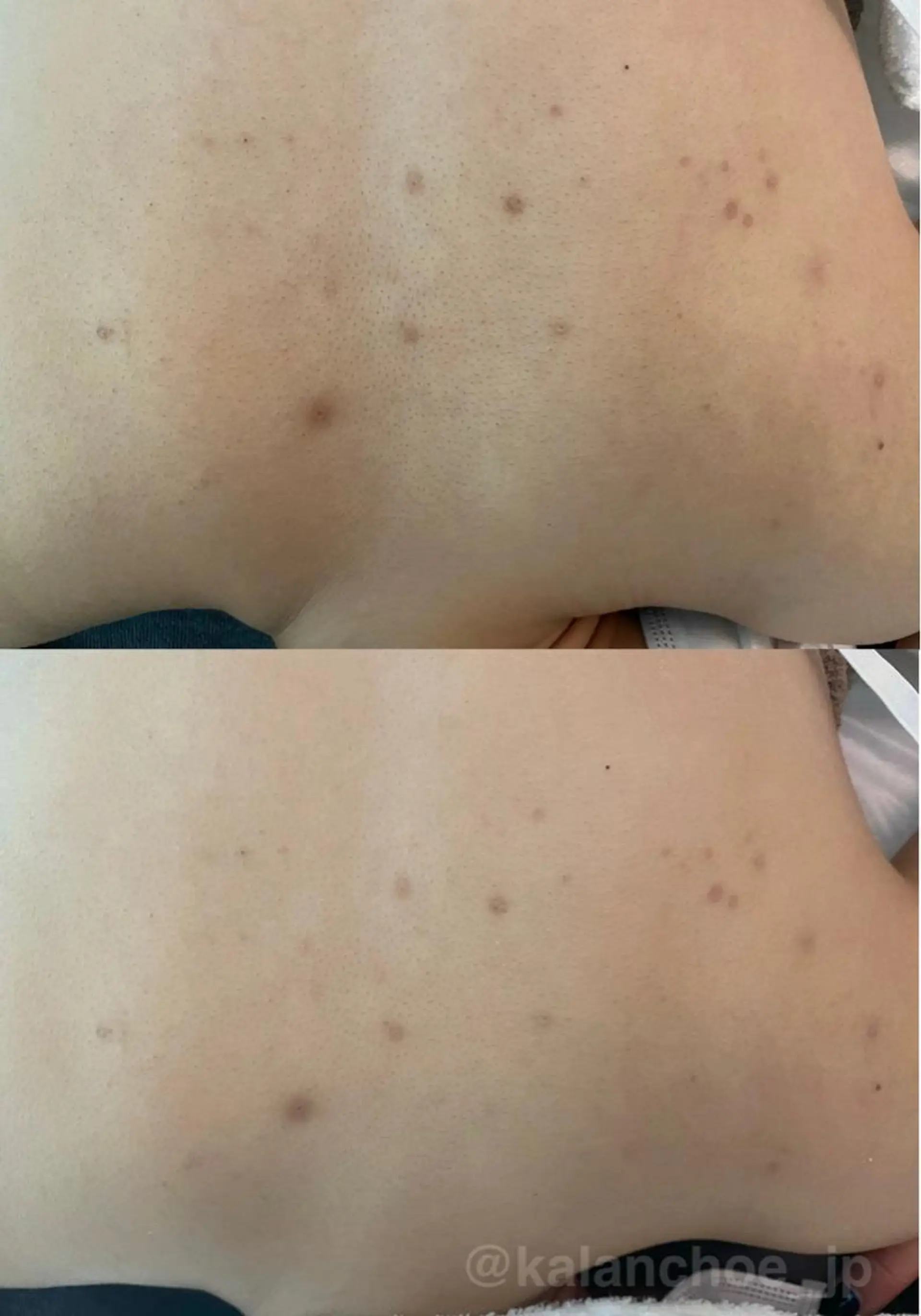 エステ 肌質改善 KALANCHOEのエステ・リラクイメージ