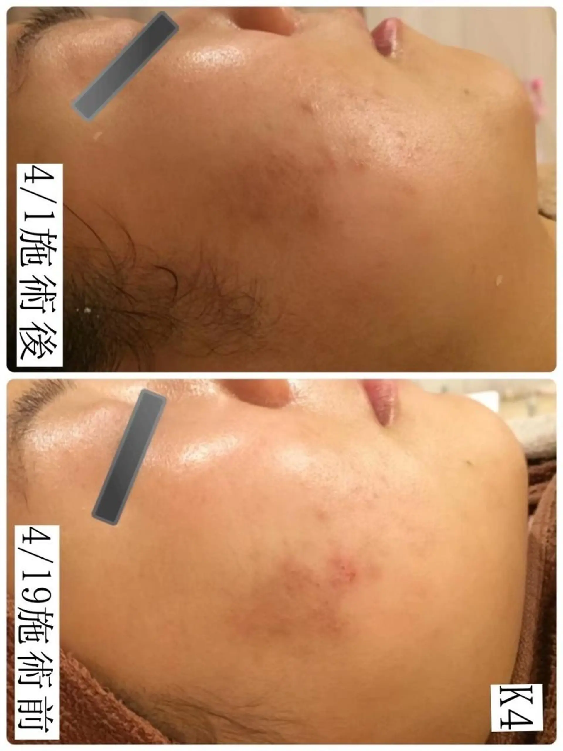 3か月で肌革命👼 ニキビ専門店💫のエステ・リラクイメージ