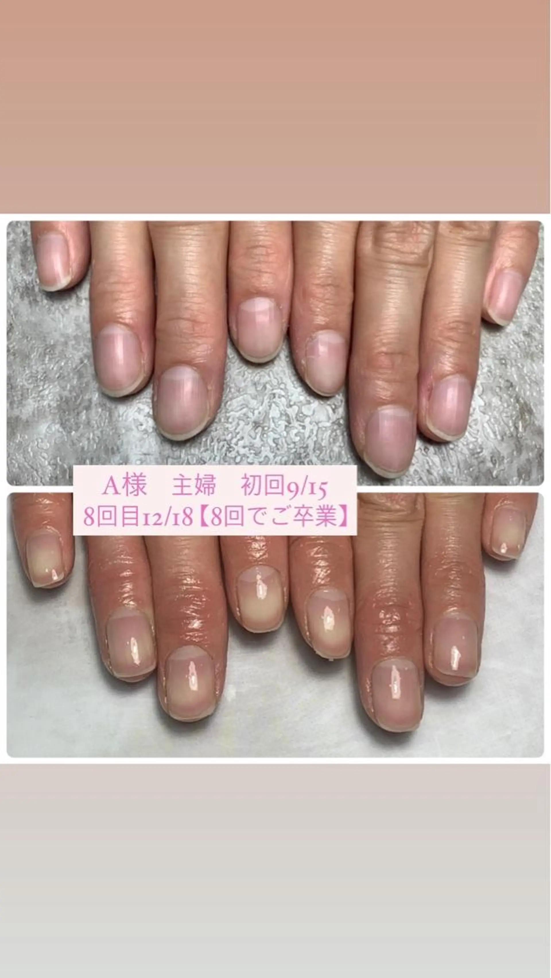 ネイル 自爪育成/深爪矯正 mikiのネイルデザイン