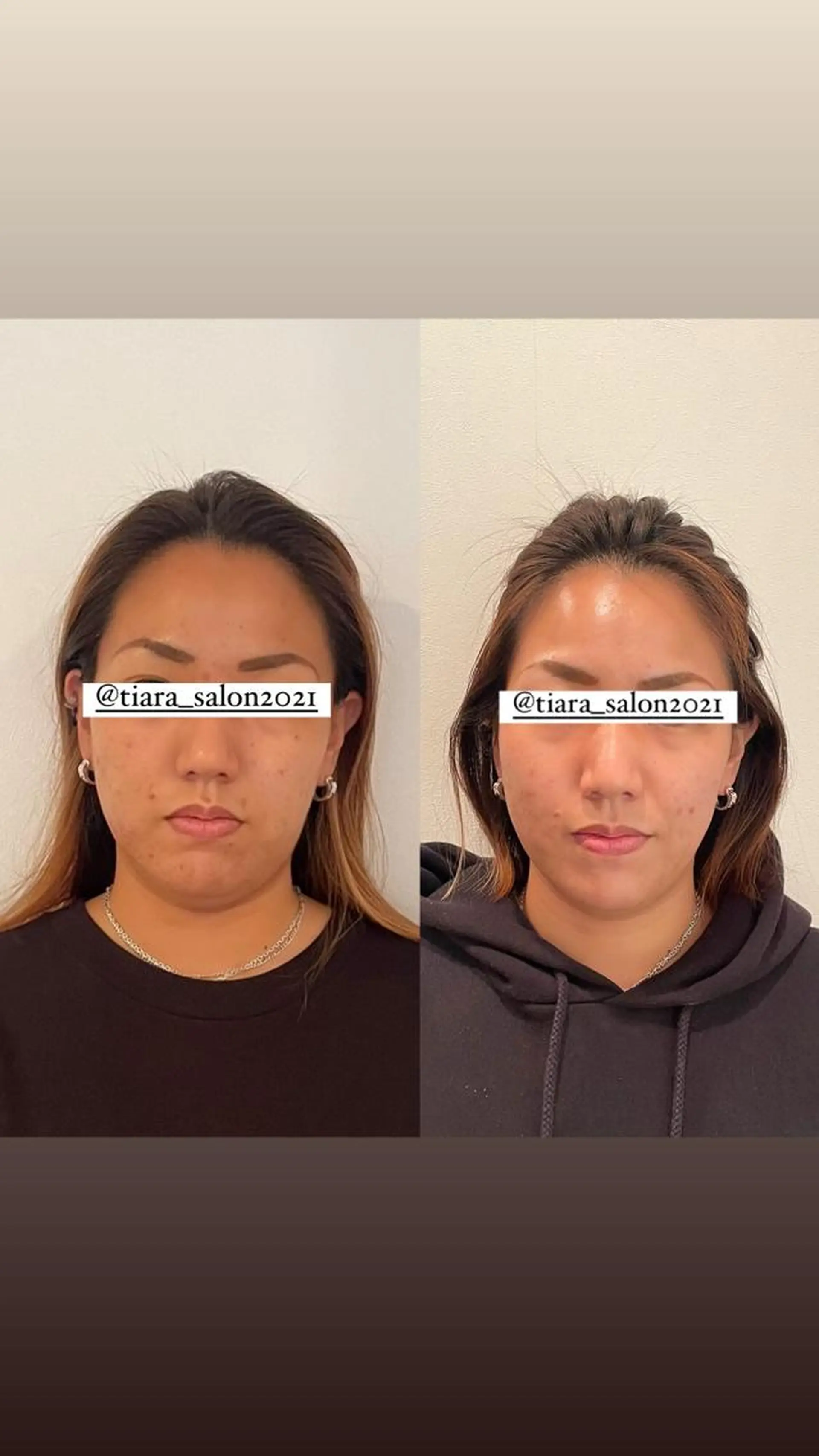 エステ リラク 鍼灸サロン TIARA　美容鍼のエステ・リラクイメージ