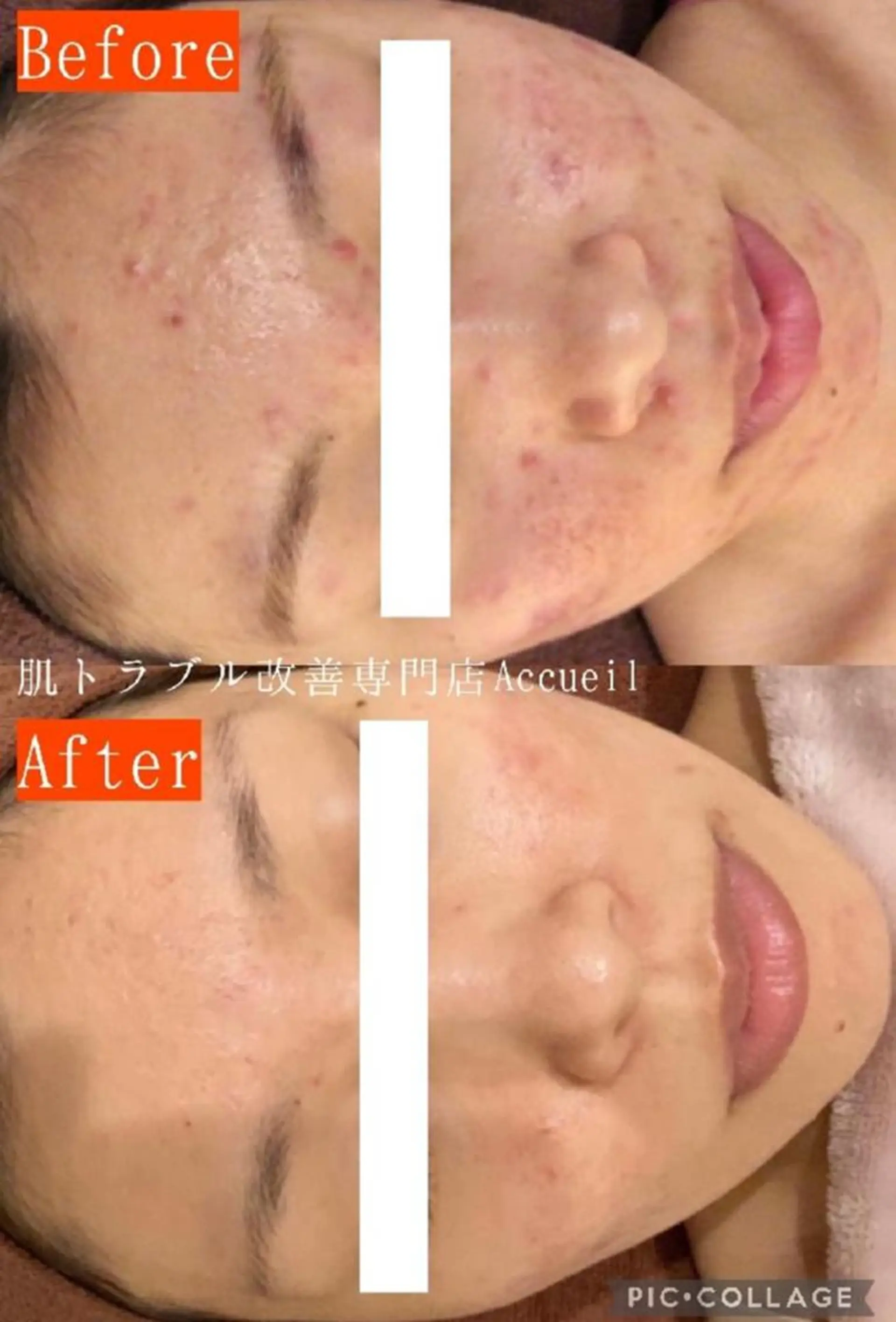 3か月で肌革命👼 ニキビ専門店💫のエステ・リラクイメージ