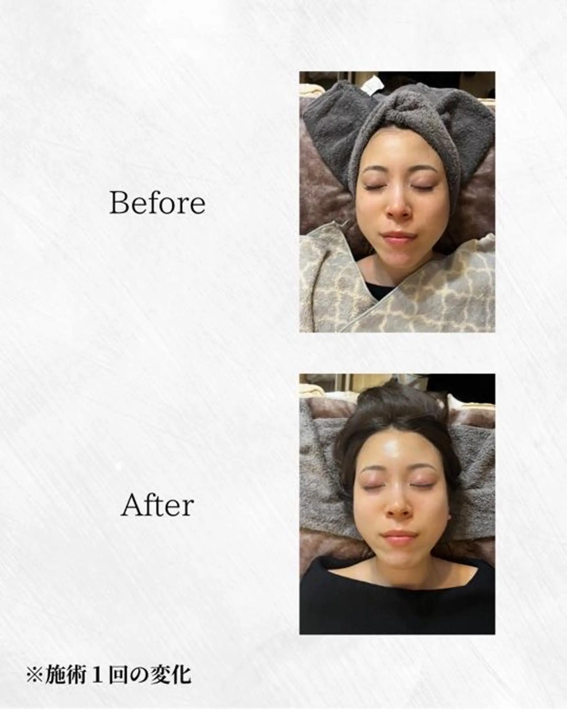 エステ ハーブピーリング🌿 REVI/Ayanoのエステ・リラクイメージ