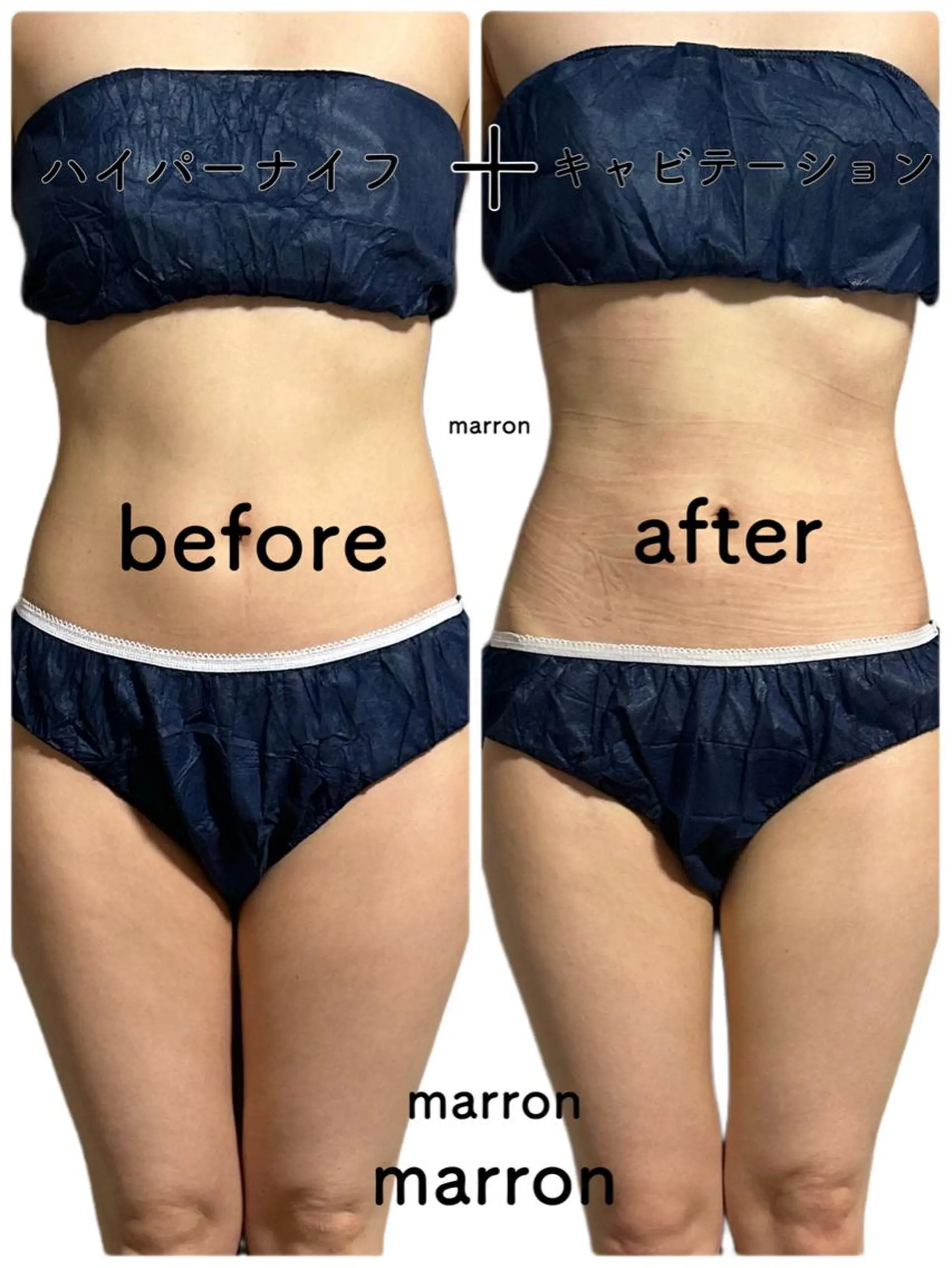 痩身ハイパーナイフ ララピールリアボーテのエステ・リラクイメージ