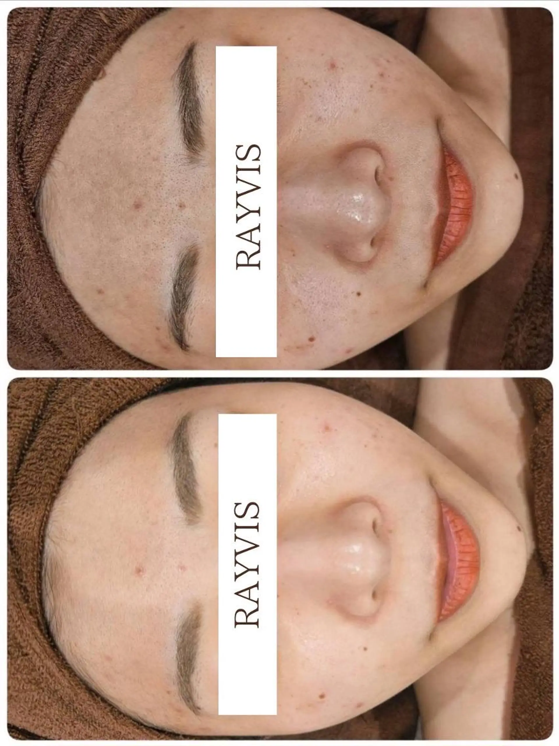 脱毛 🖤RAYVIS🖤 青森店　豊島のエステ・リラクイメージ