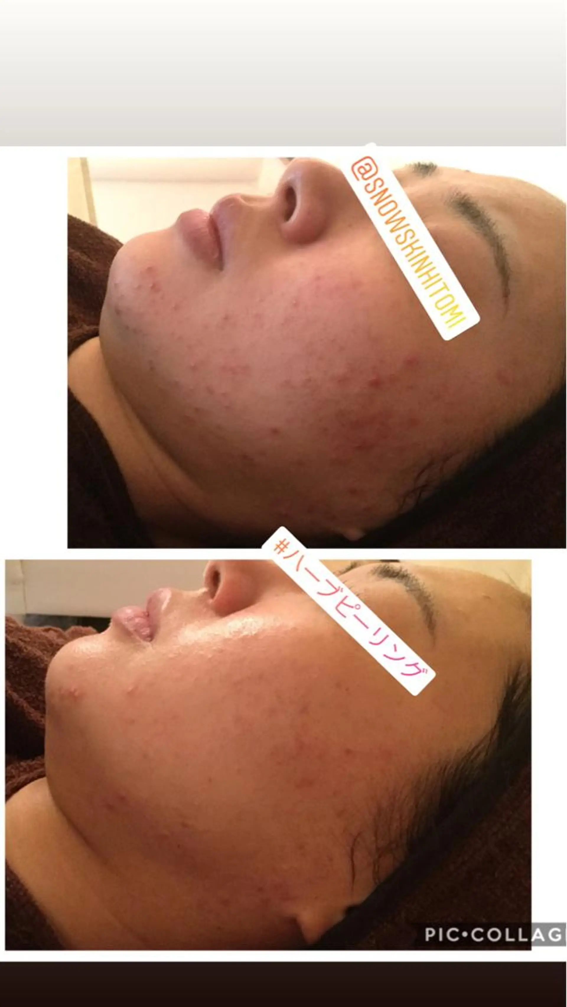 エステ リラク ニキビ/肌質改善専門 Snow skinのエステ・リラクイメージ