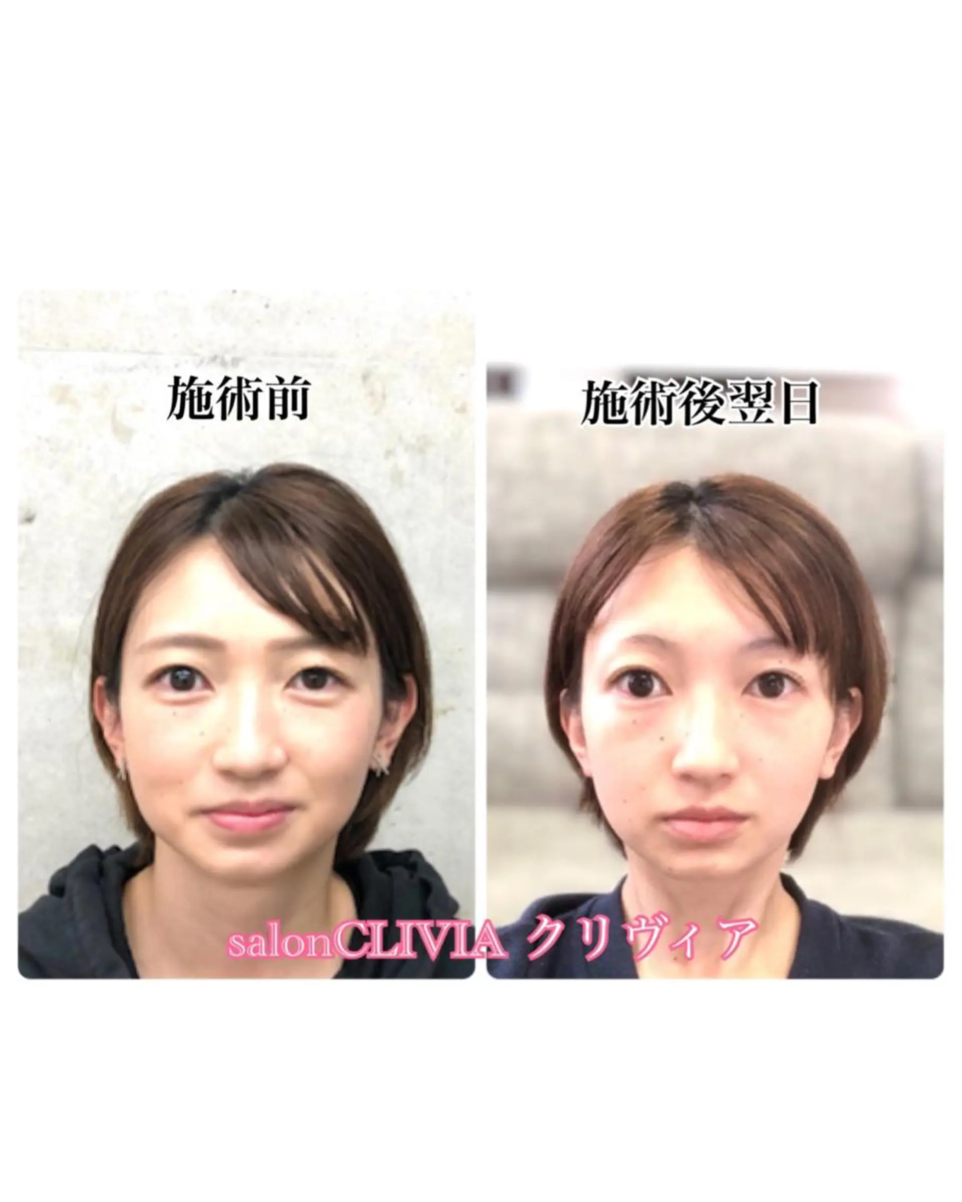 無痛小顔矯正 クリヴィアのエステ・リラクイメージ
