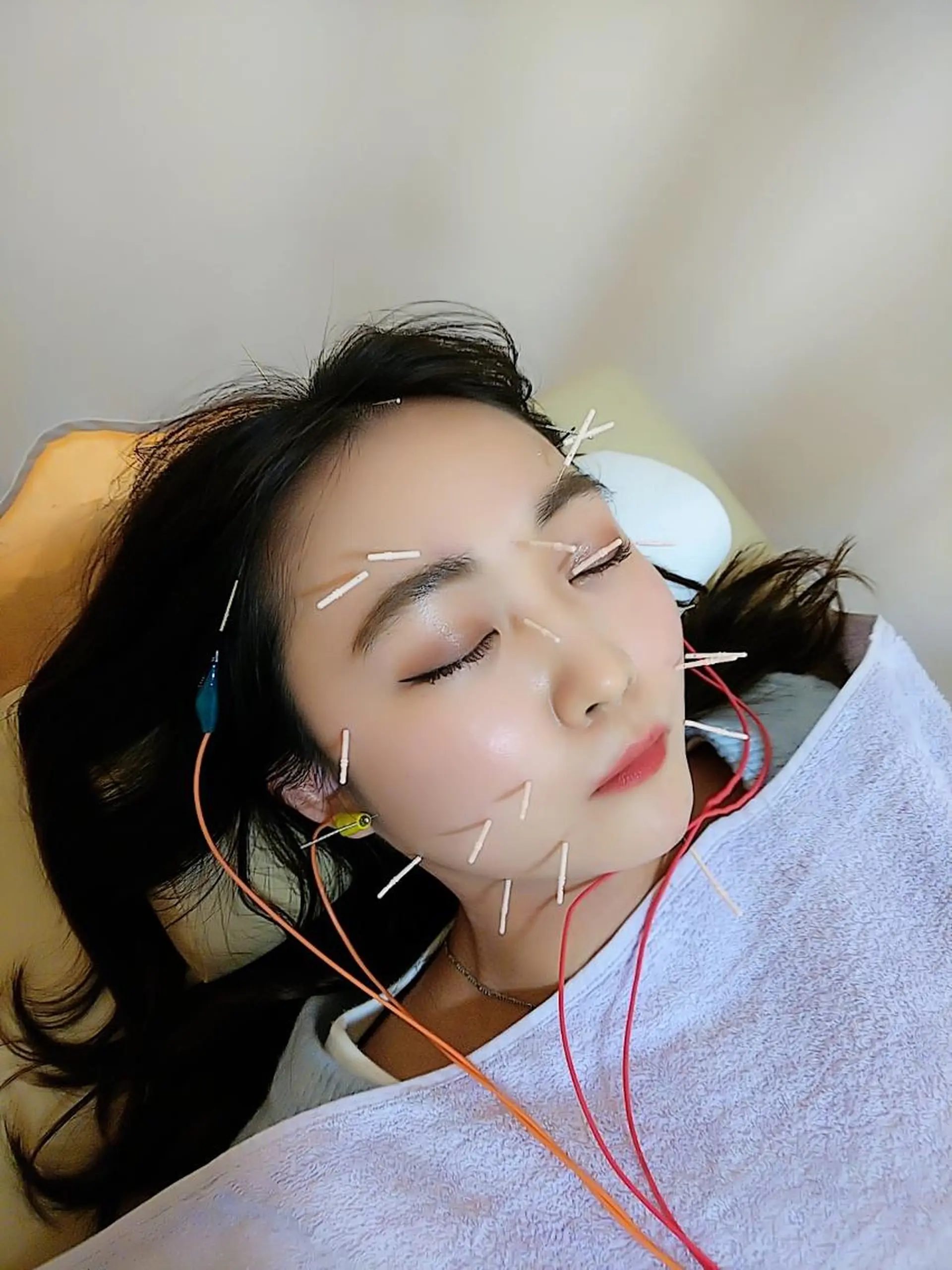 リフトアップ・たるみ ☆美容鍼小顔矯正のその他イメージ