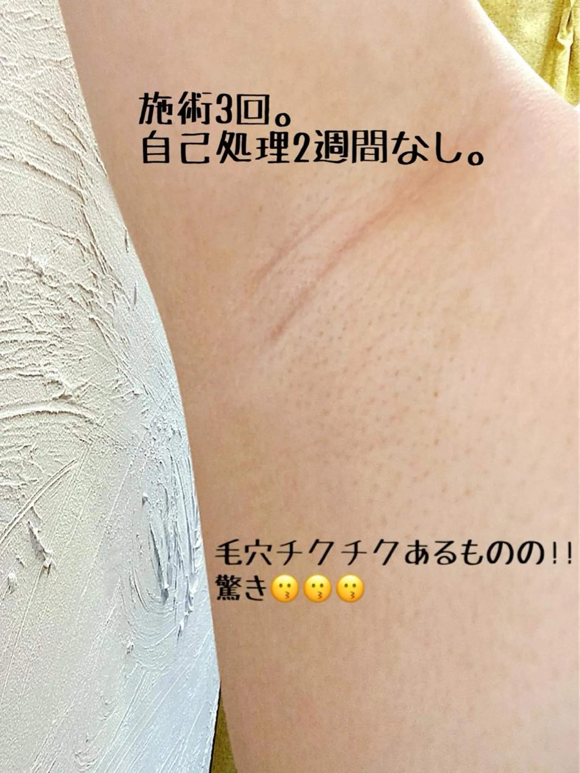 脱毛 セルフ脱毛 atelier aoのエステ・リラクイメージ