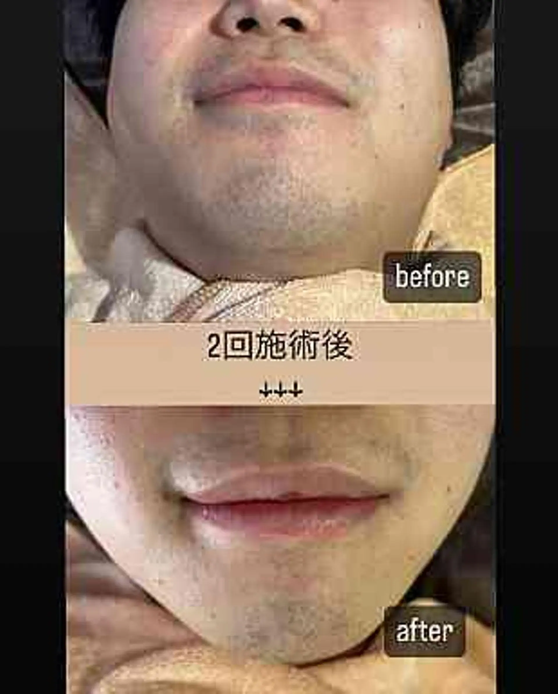 メンズ 脱毛 Felice🌸脱毛 ・光フェイシャルのエステ・リラクイメージ