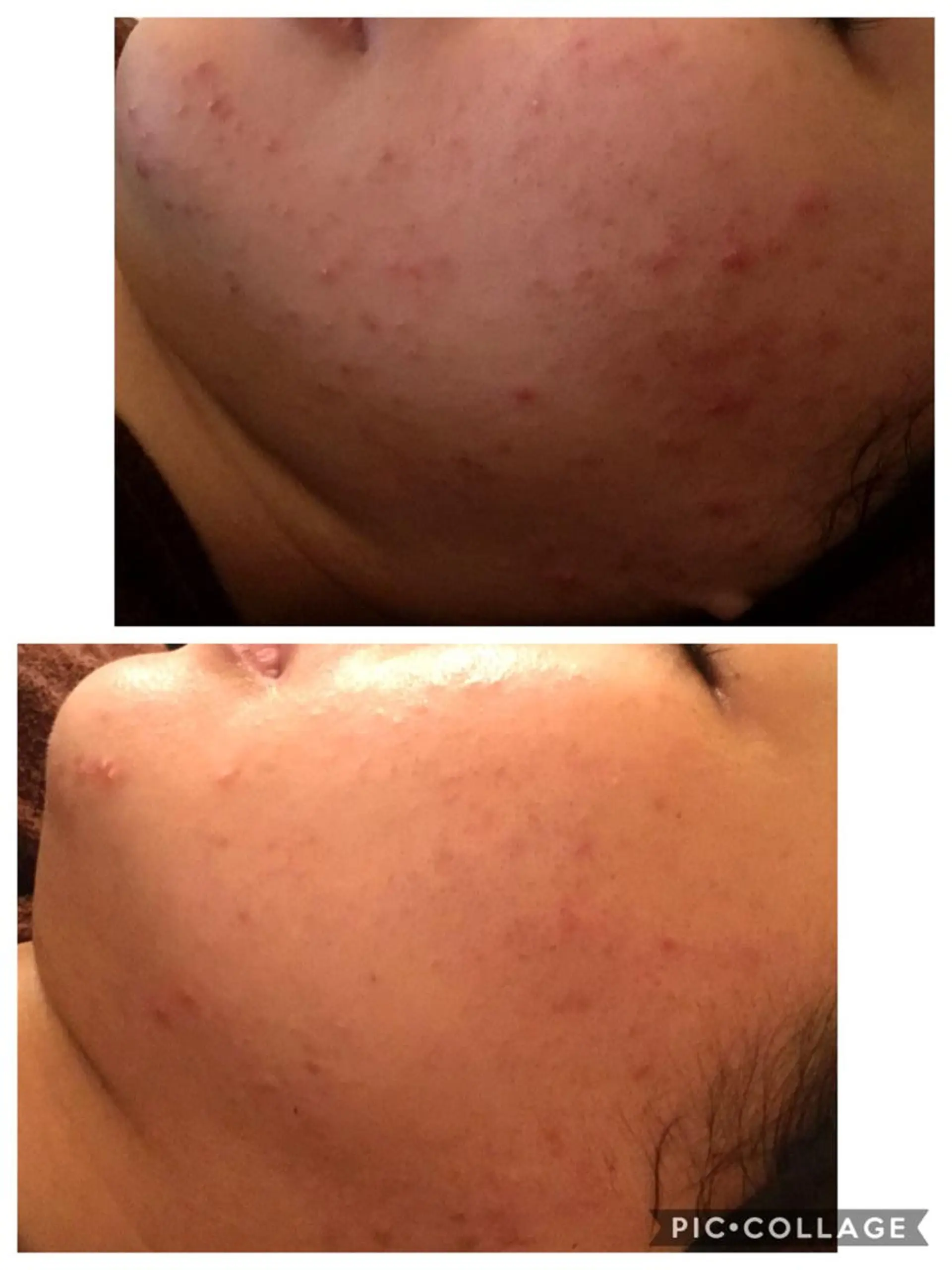 エステ リラク ニキビ/肌質改善専門 Snow skinのエステ・リラクイメージ