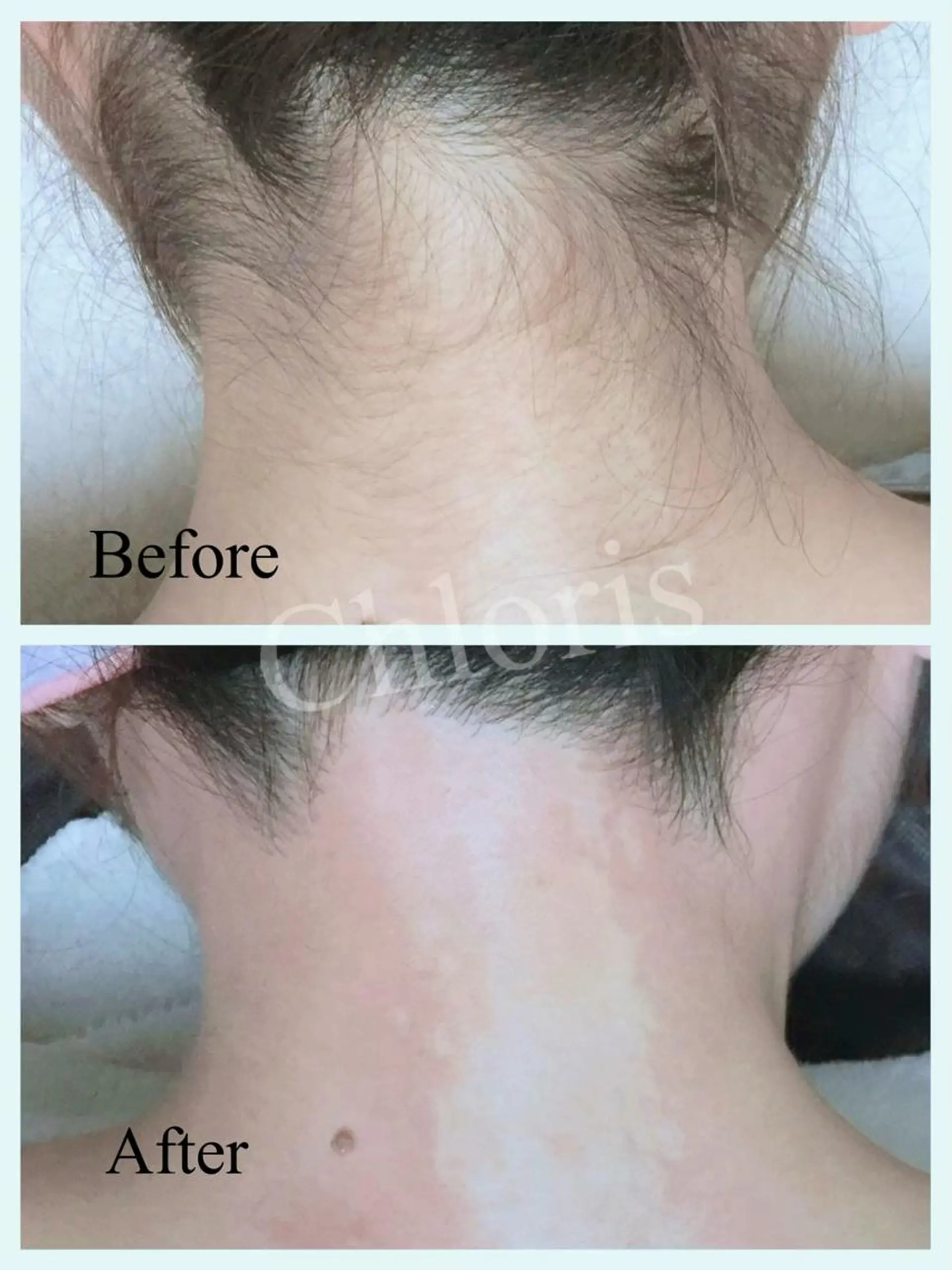 川越デリケートゾーン 光脱毛/ワックス脱毛のエステ・リラクイメージ