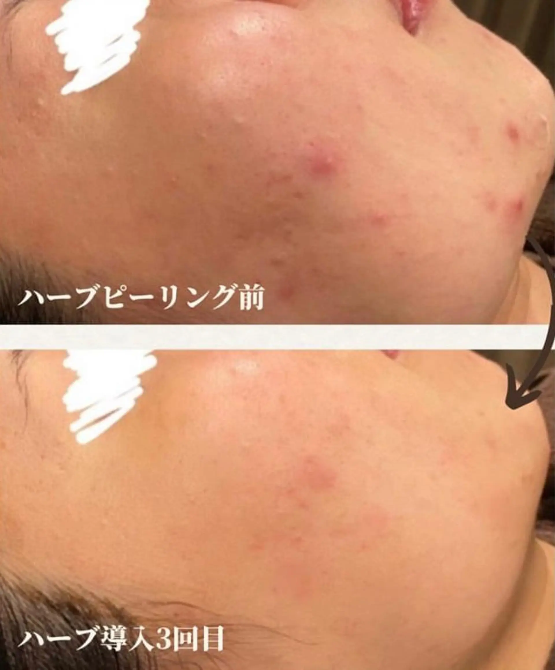 本気の肌質改善スキン デトックス🌿のエステ・リラクイメージ