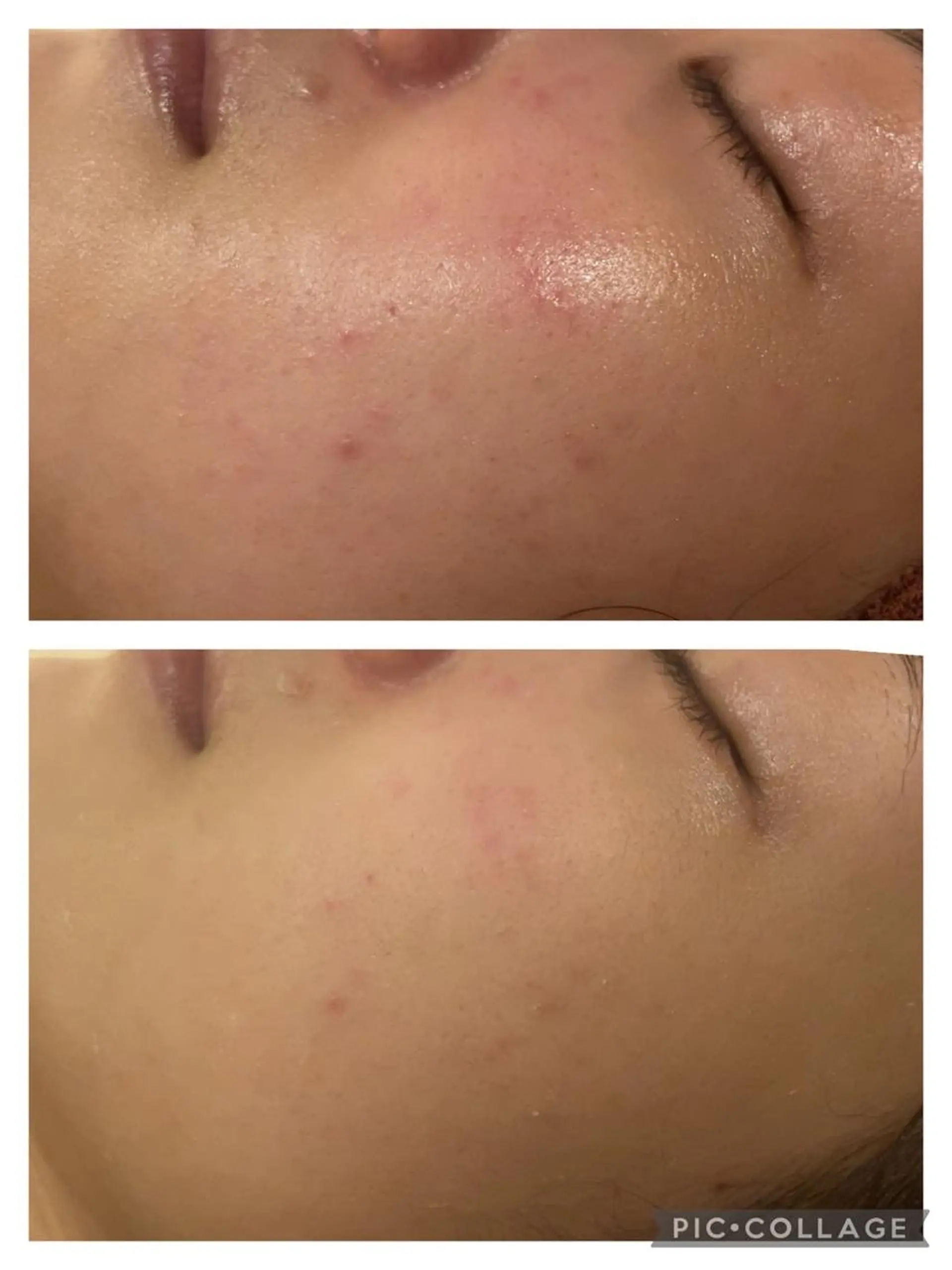 セミロング カラー パーマ ヘアアレンジ メンズ キッズ ネイル マツエク・マツパ アイブロウ 3か月で肌革命👼 ニキビ専門店💫のエステ・リラクイメージ