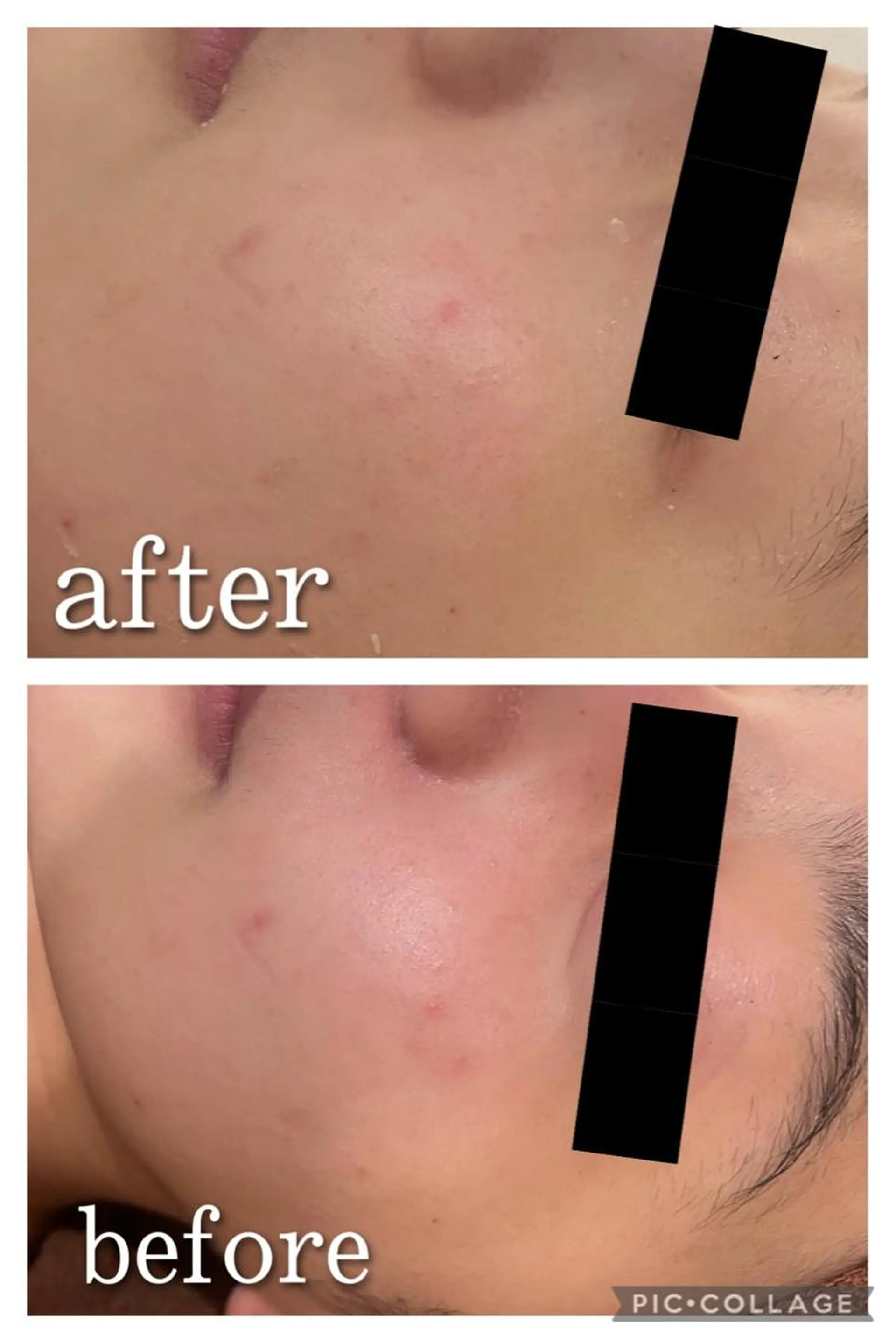 セミロング カラー パーマ ヘアアレンジ メンズ キッズ ネイル マツエク・マツパ アイブロウ エステ リラク ニキビ特化型エステ 🍋最短で肌質改善のエステ・リラクイメージ