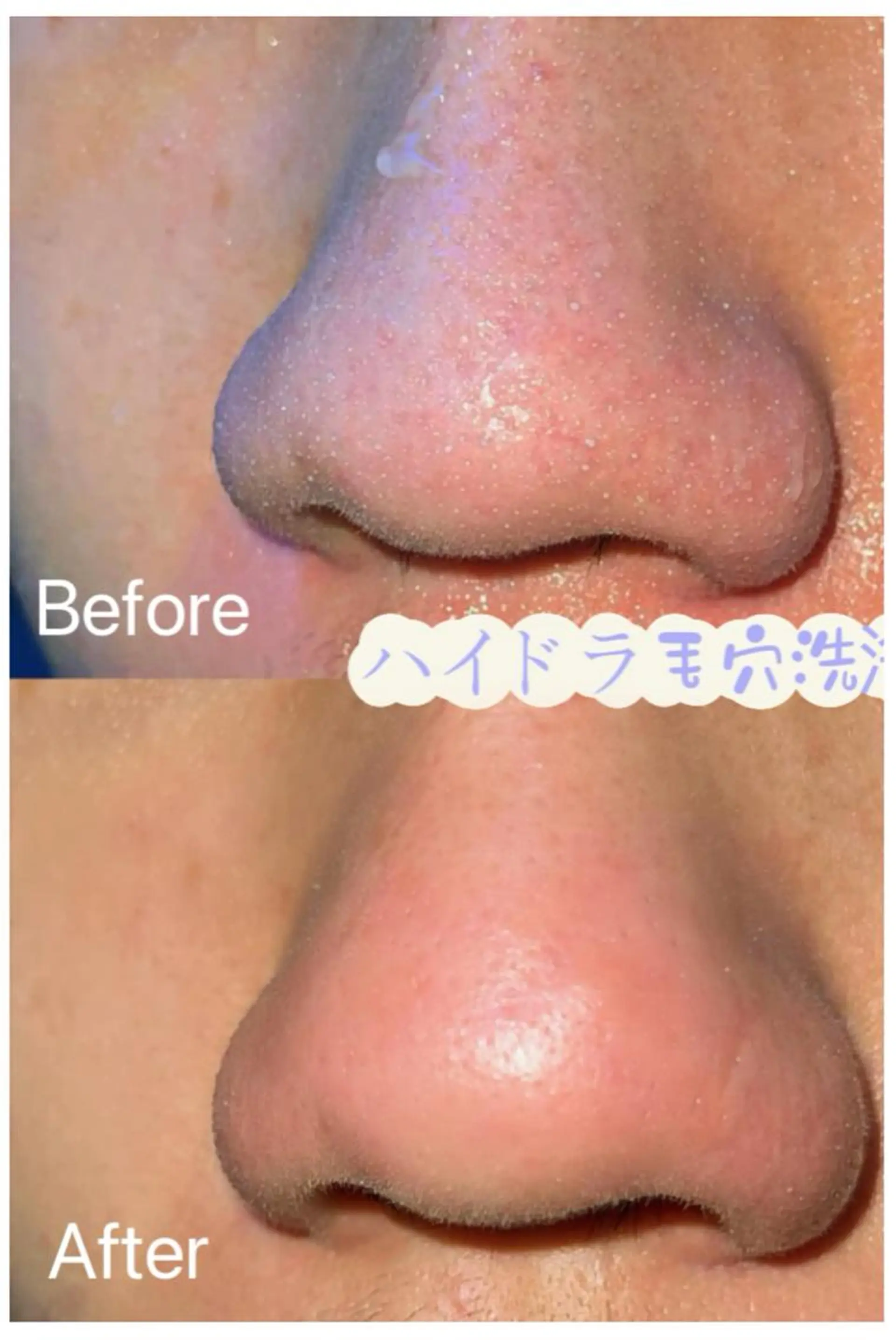 エステ リラク 毛穴洗浄& 睫毛パーマ上野御徒町のマツエク・マツパデザイン