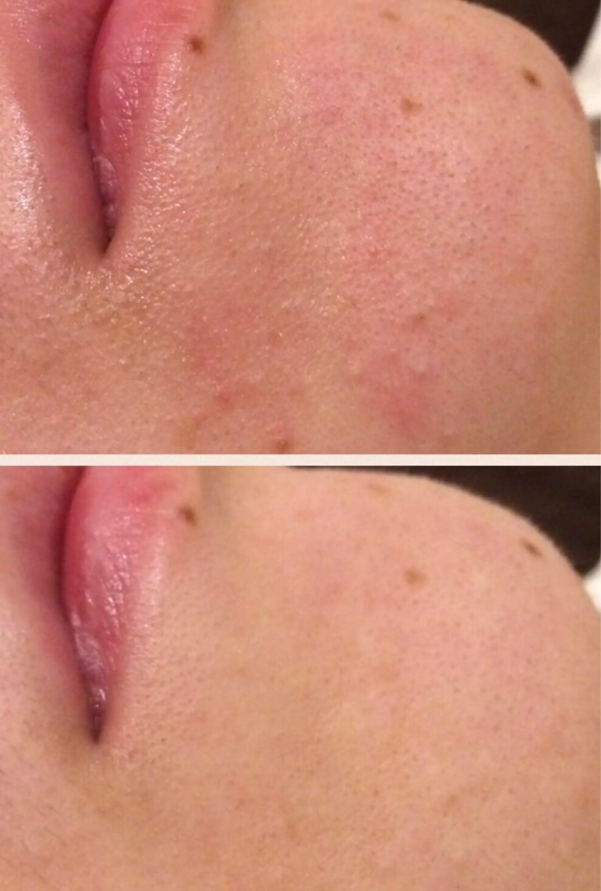 メンズ 金の糸脱毛 産毛ケア専門のエステ・リラクイメージ