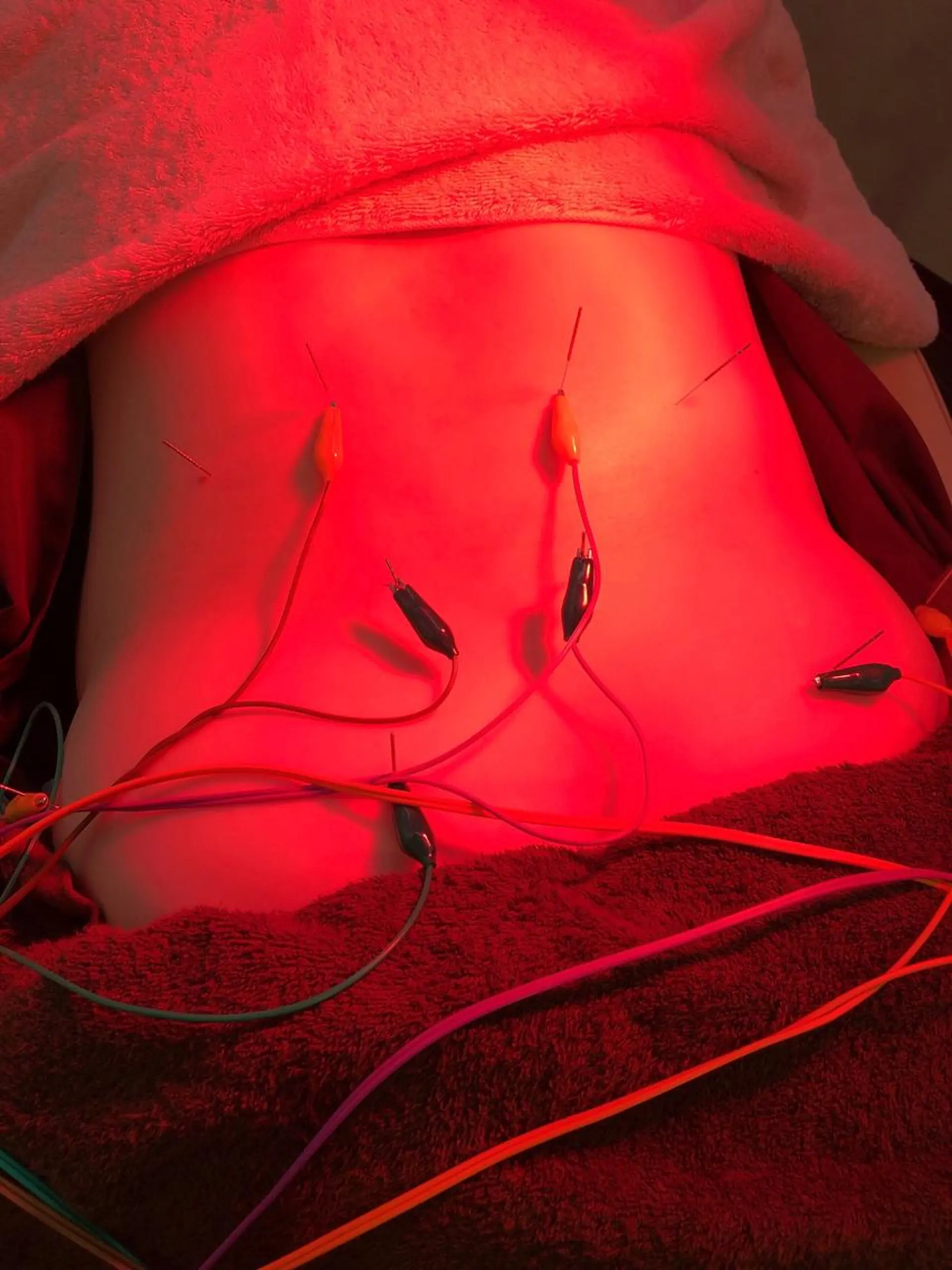 その他 小顔矯/美容鍼/鍼灸 BeauJuのその他イメージ