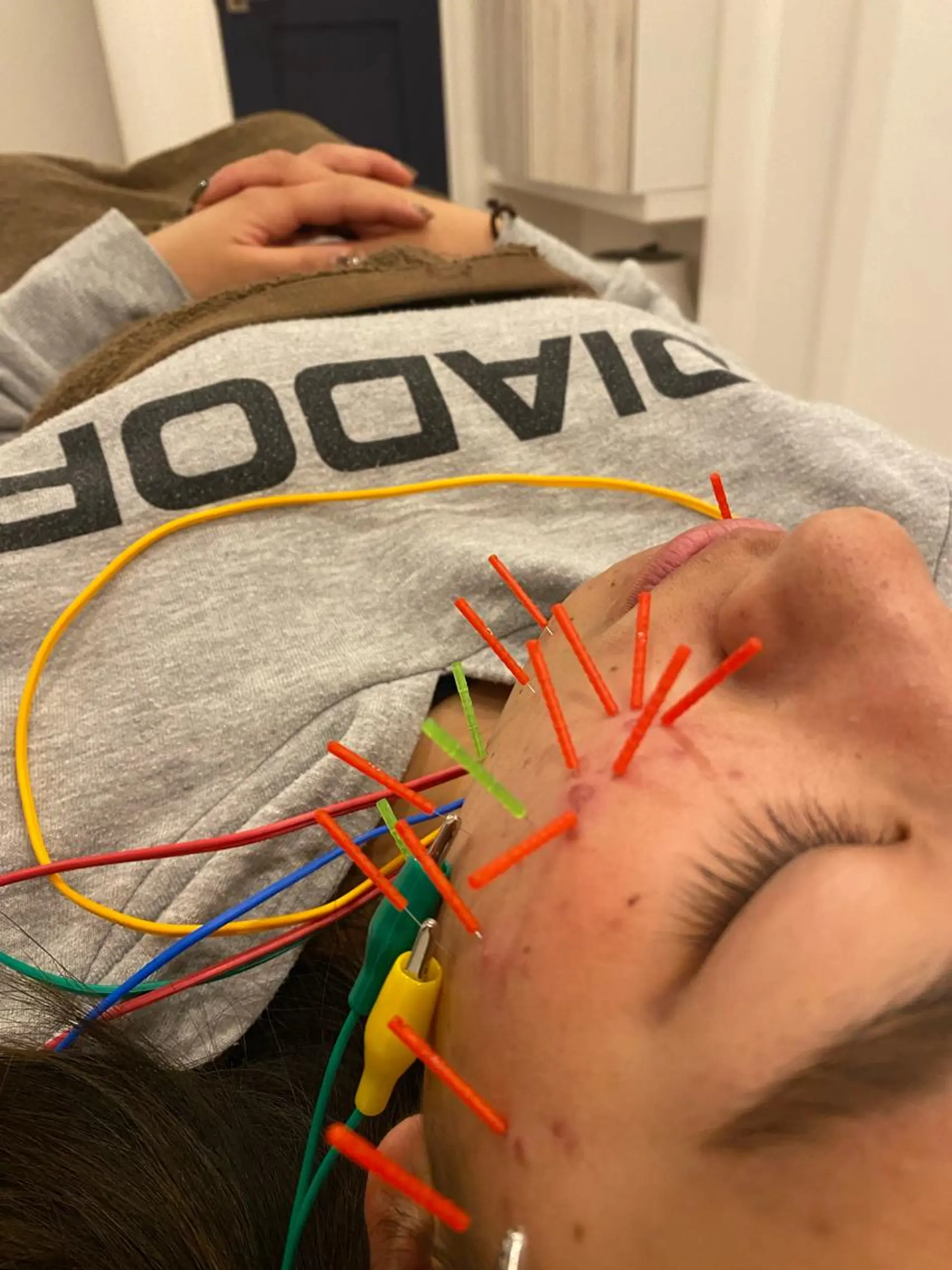 エステ リラク 肌質改善×美容鍼 ゆいのエステ・リラクイメージ