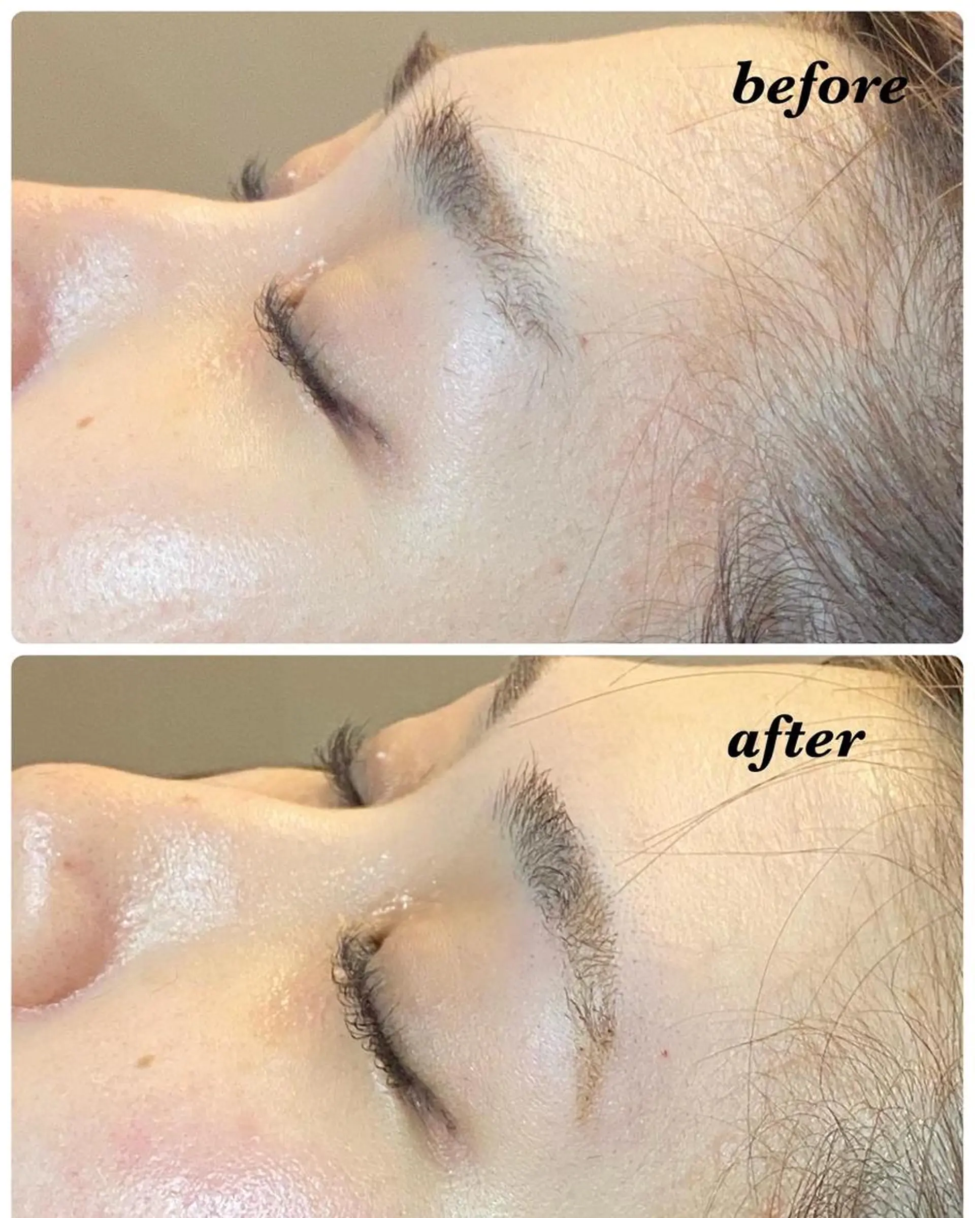 アイブロウ ハーブピーリング/韓国肌管理/フェイシャル/毛穴洗浄/眉毛/顔脱毛【糸脱毛専門】rev所属・ハーブピーリング専門 毛穴洗浄❤️眉waxのエステ・リラクイメージ