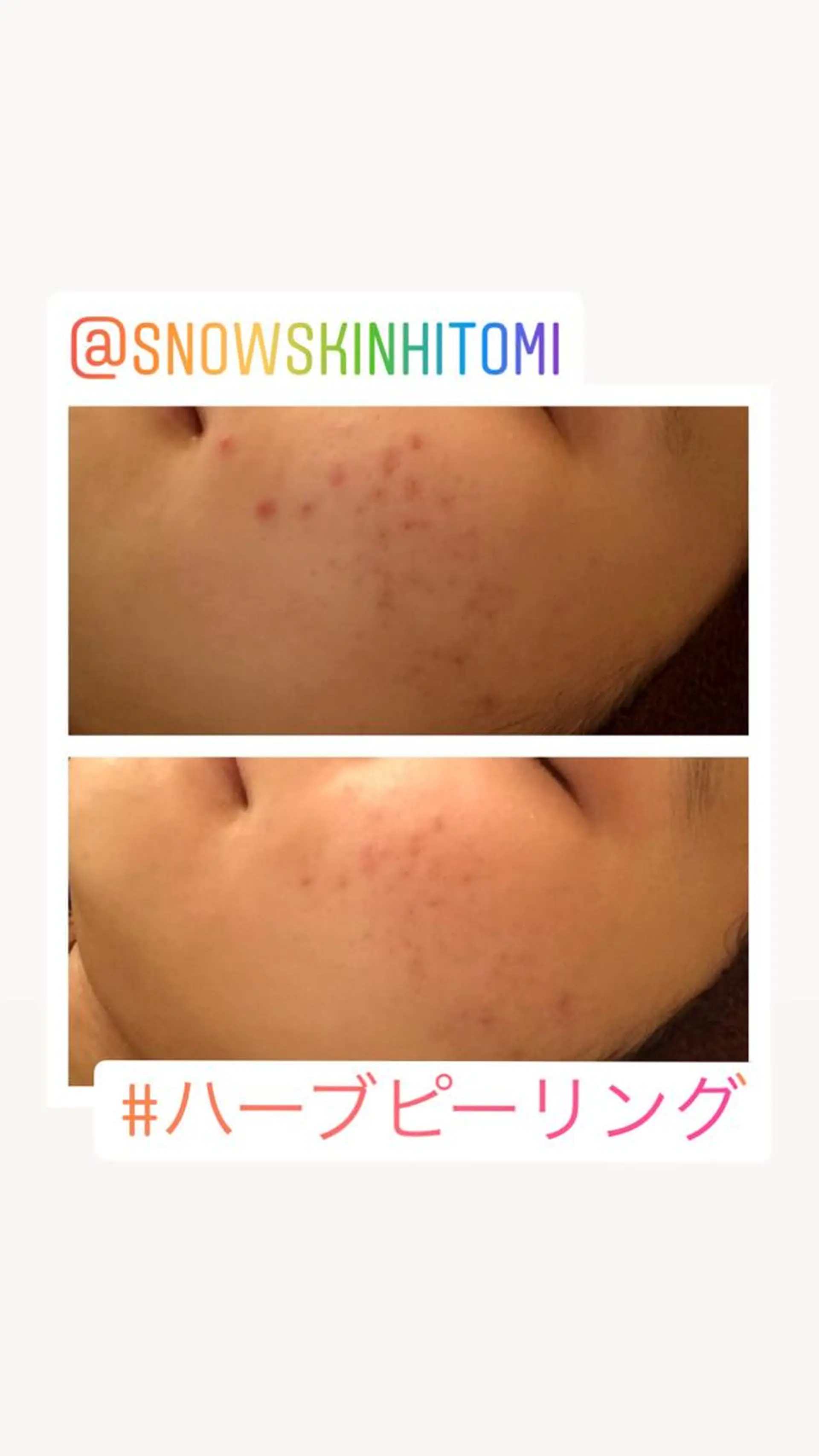 エステ リラク ニキビ/肌質改善専門 Snow skinのエステ・リラクイメージ