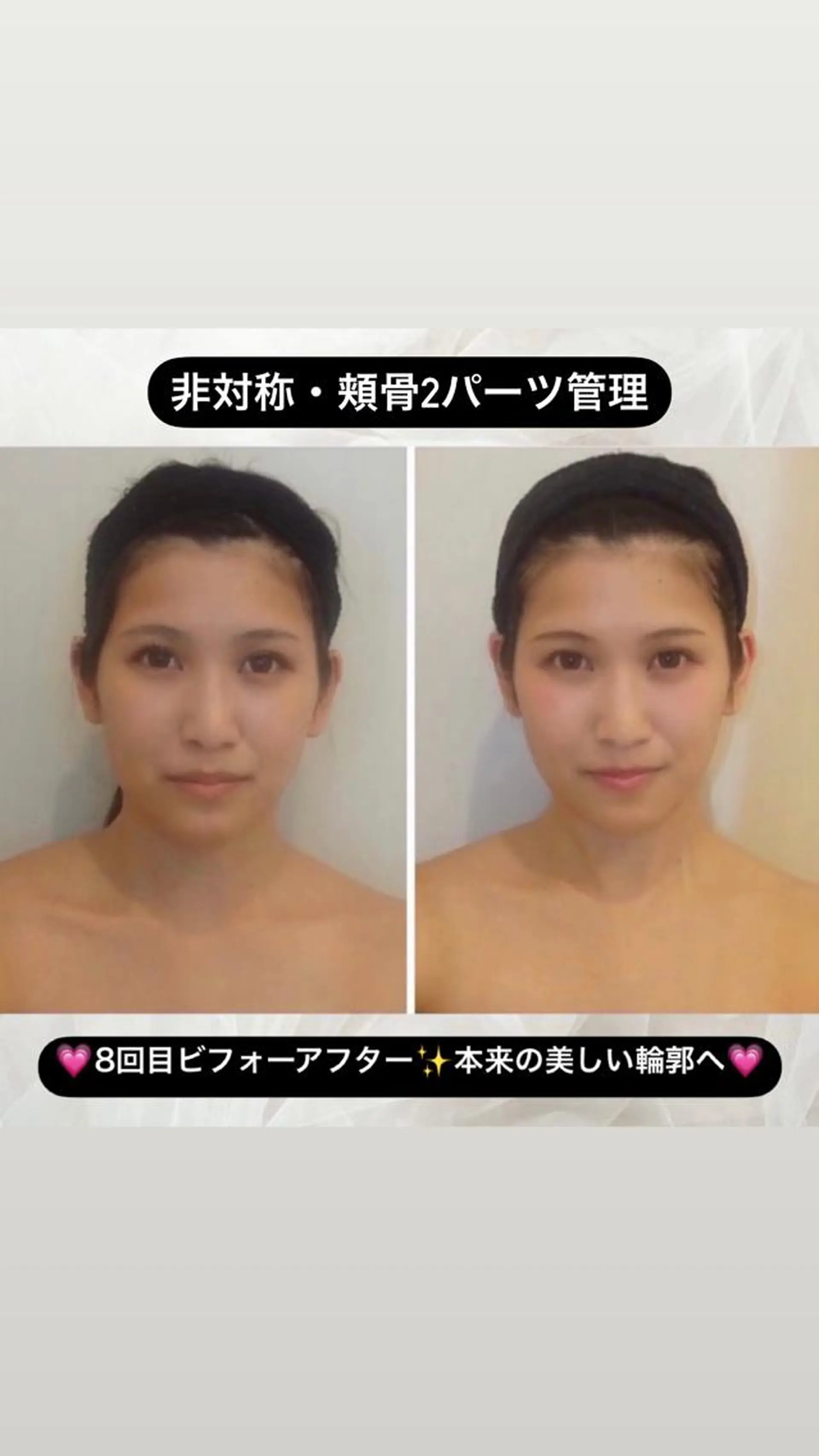 整形級の変化👀 最新✨韓国小顔管理のエステ・リラクイメージ