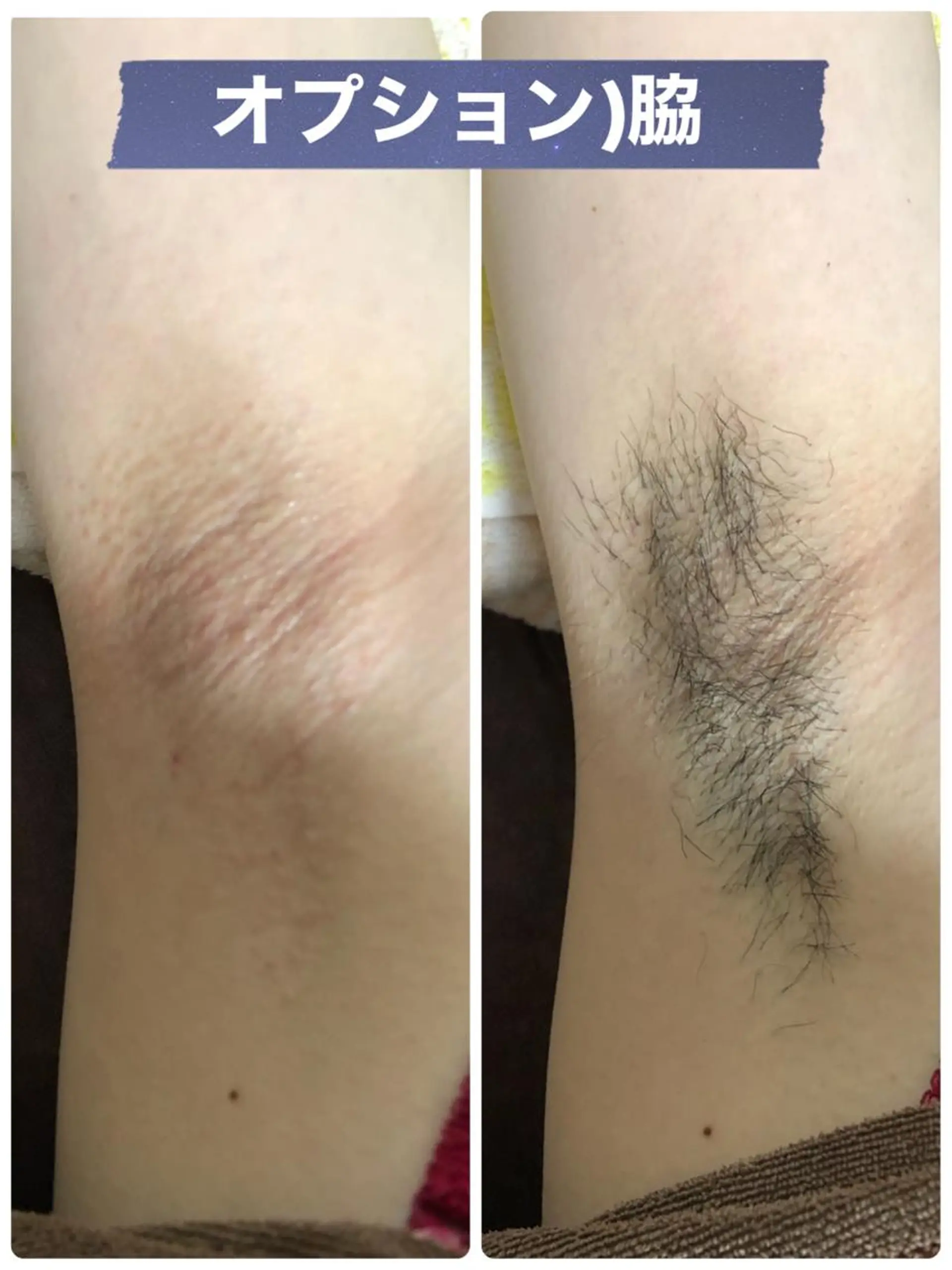 脱毛 ブラジリアン☆WAX 🎖🌚YUKI🌚のエステ・リラクイメージ