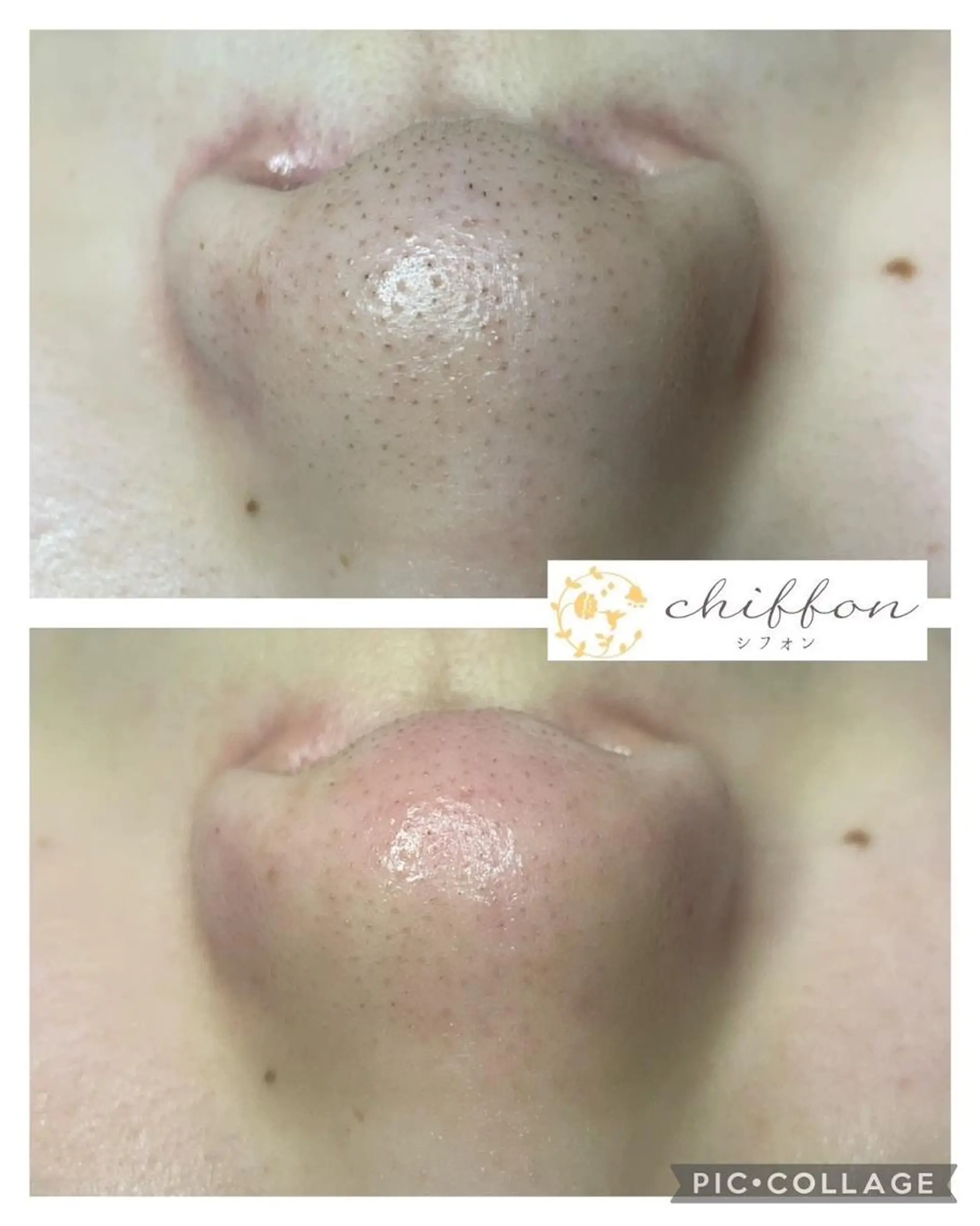 エステ 毛穴黒ずみ改善🥇 ✨シフォン豊田✨のエステ・リラクイメージ