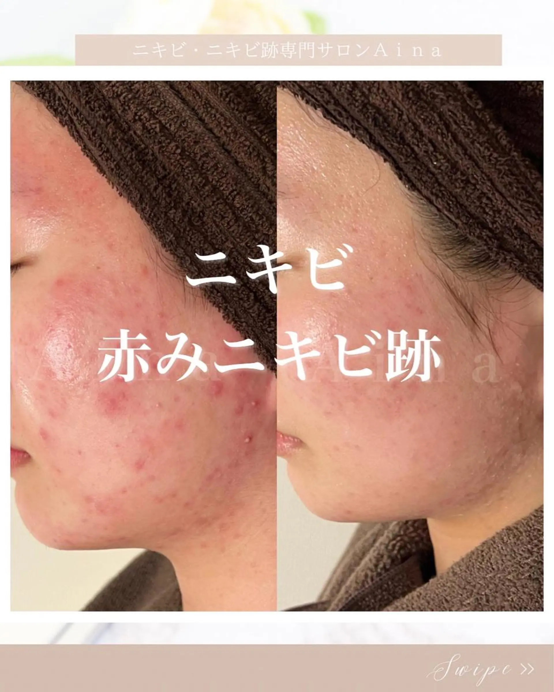 ミディアム パーマ ヘアアレンジ メンズ キッズ ネイル アイブロウ エステ リラク ニキビ跡専門サロン Ａｉｎａのエステ・リラクイメージ