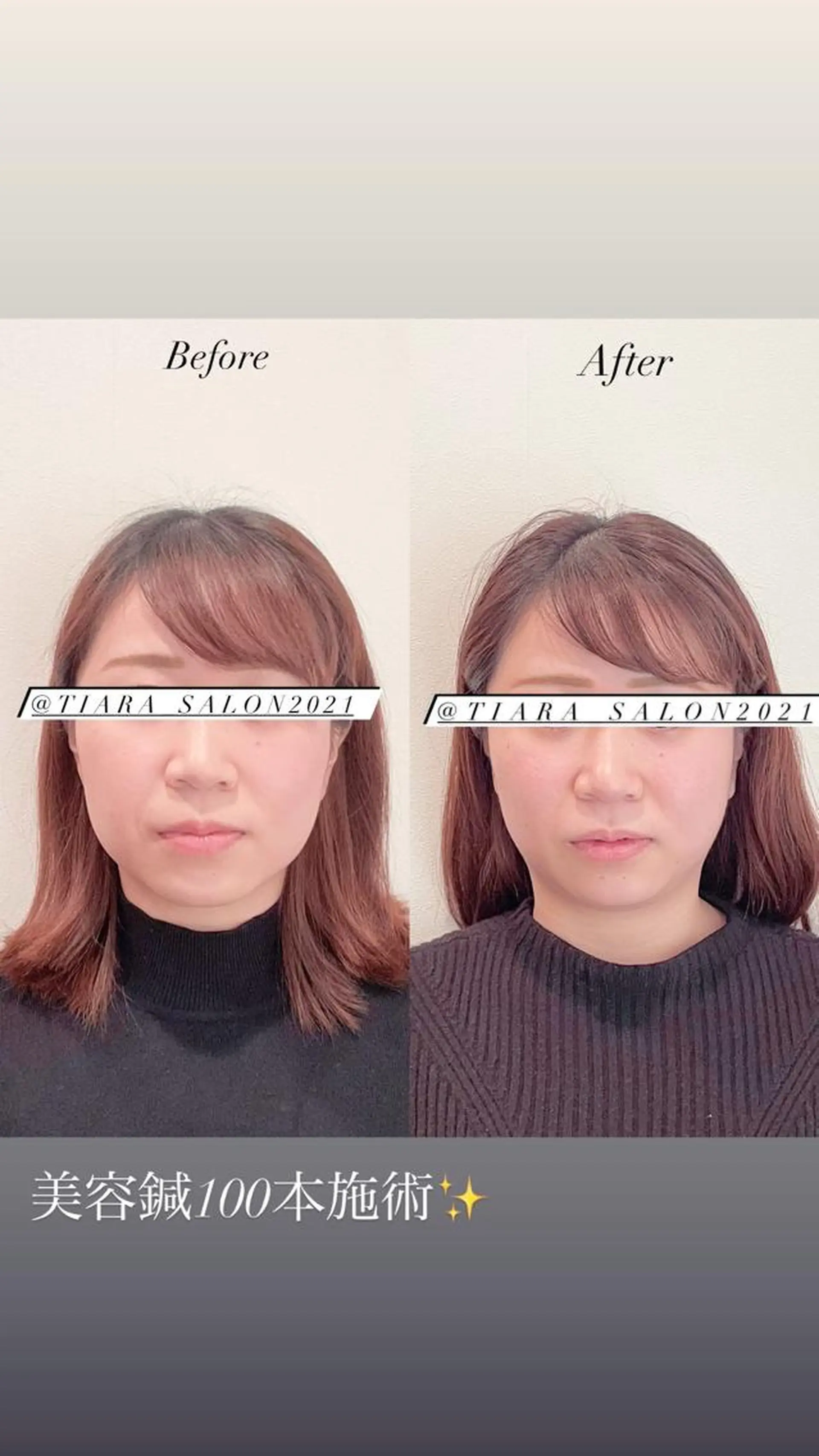 鍼灸サロン TIARA　美容鍼のエステ・リラクイメージ